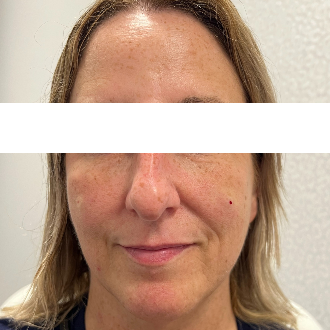 Cheek Filler After Patient 4