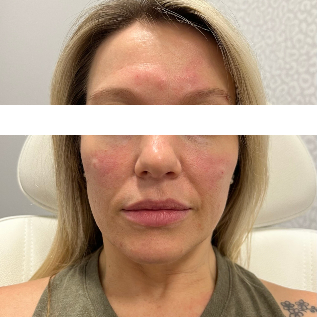 Cheek Filler After Patient 5