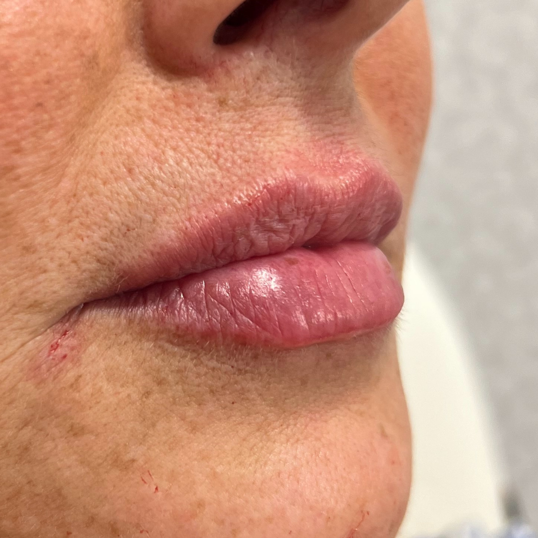 Lip Filler After Patient 23