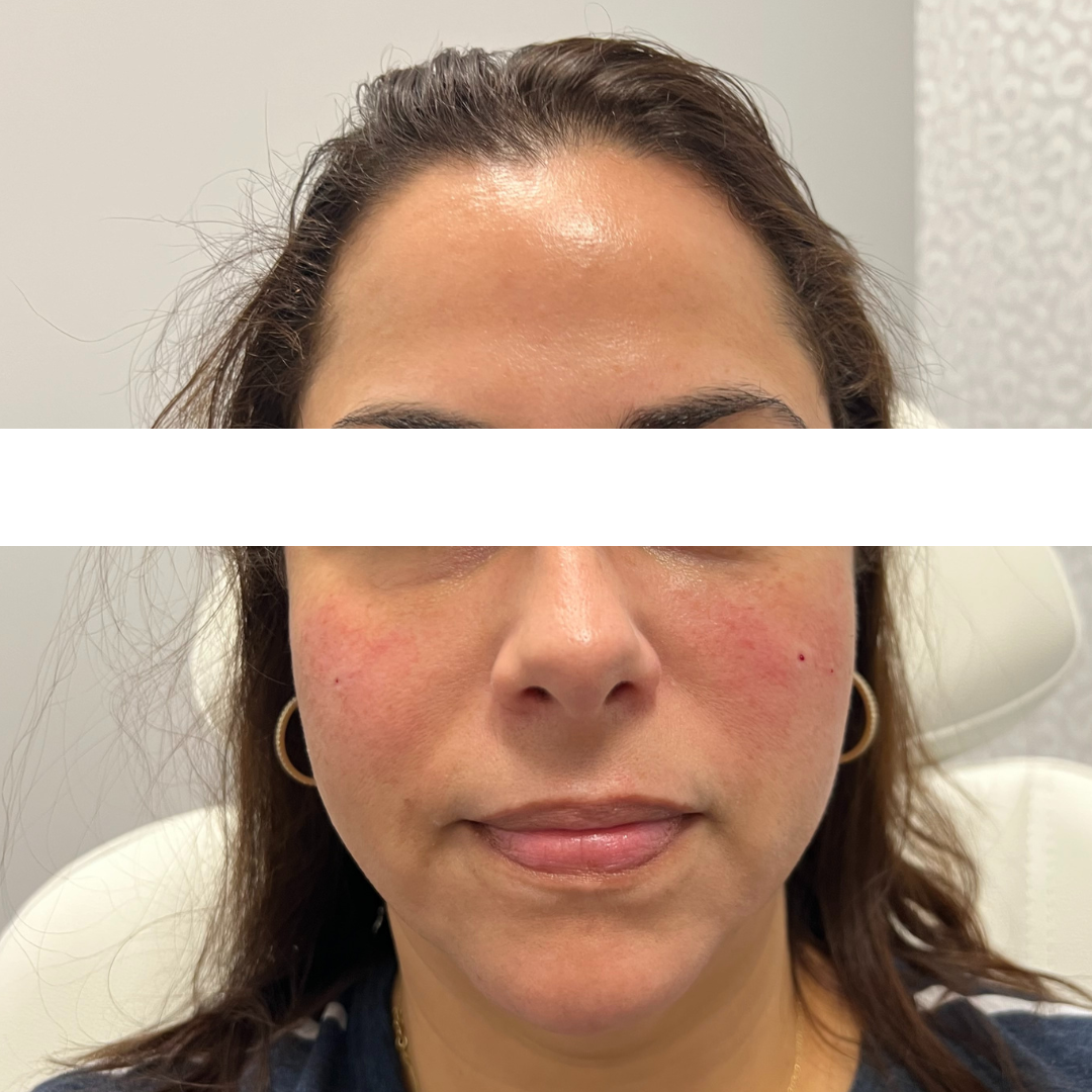 Cheek Filler After Patient 6