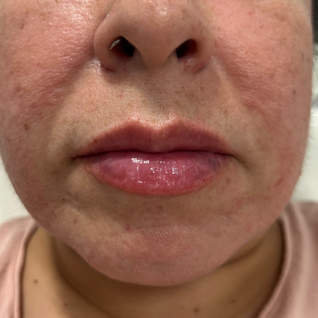 Lip Filler After Patient 25