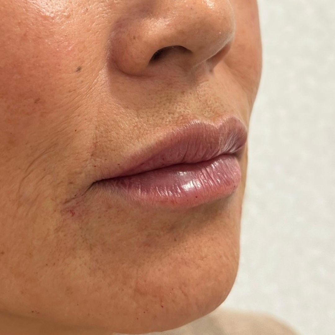 Lip Filler After Patient 27