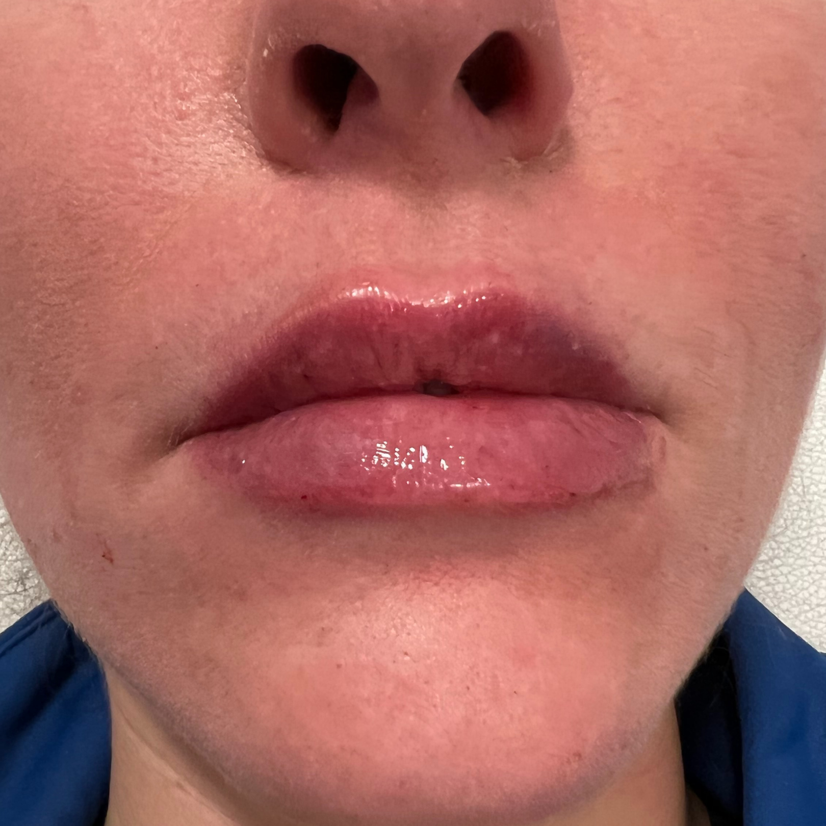 Lip Filler After Patient 1