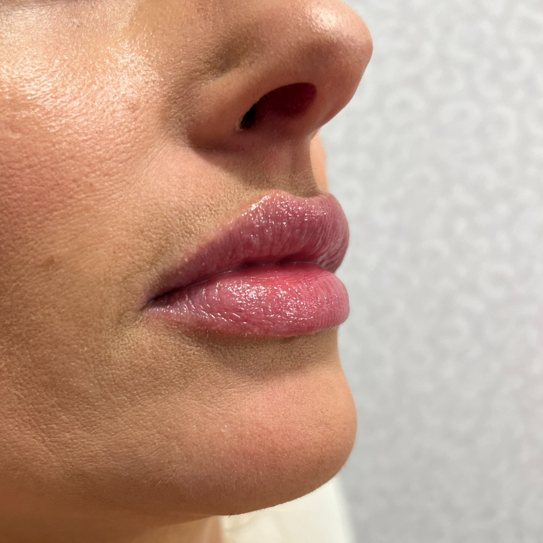 Lip Filler After Patient 29