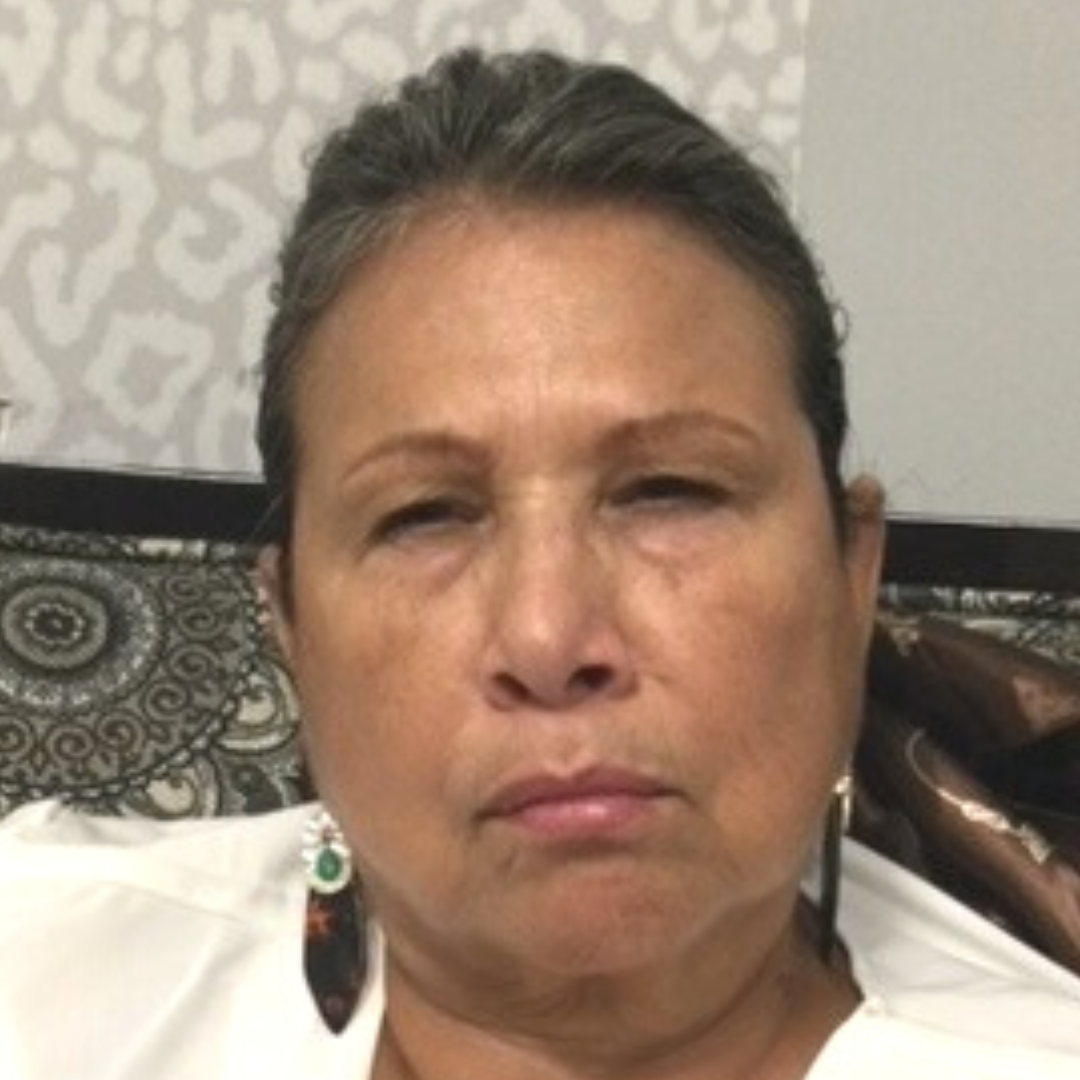 Botox and Dysport After Patient 4