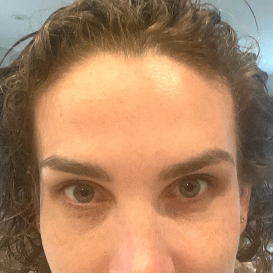 Botox and Dysport After Patient 5