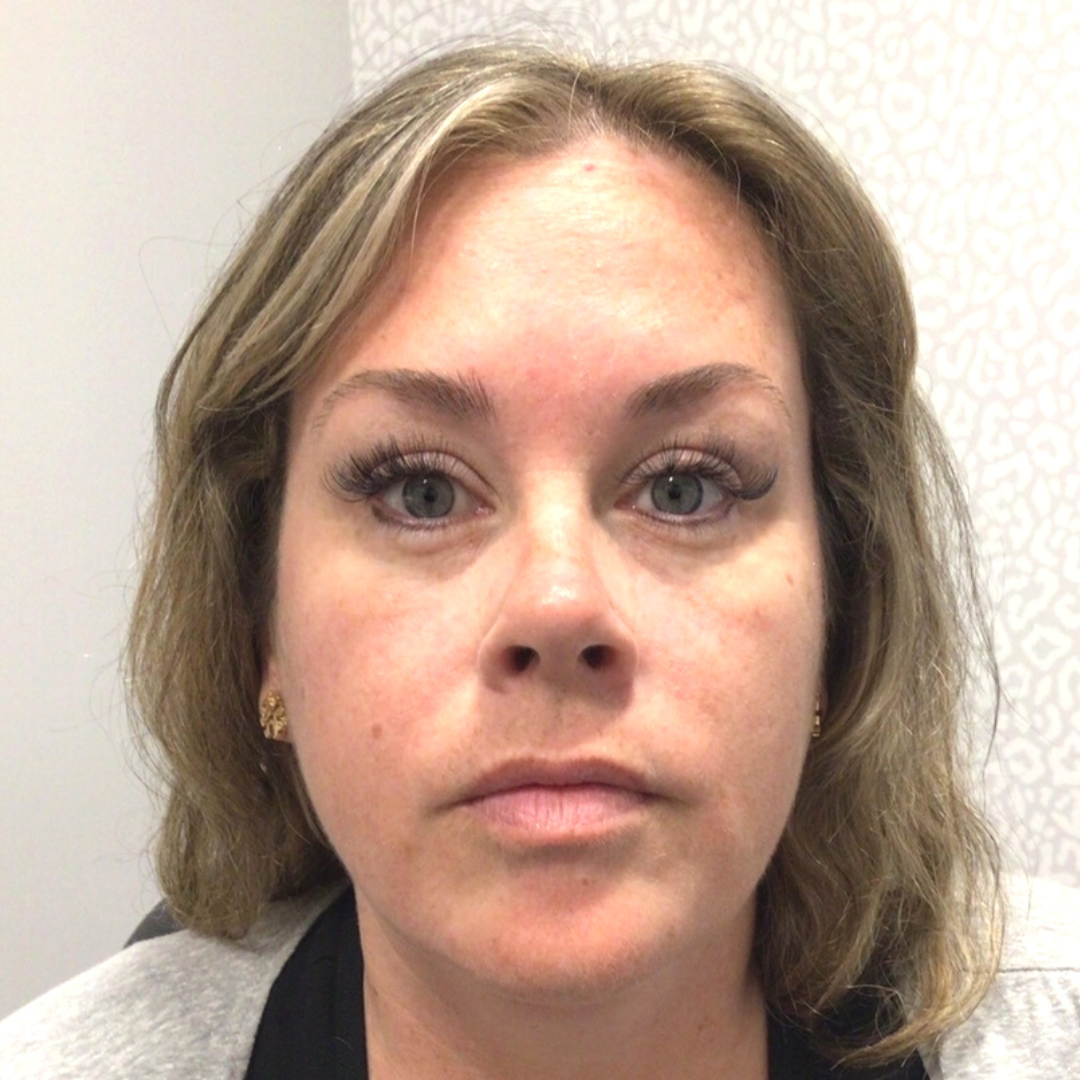 Injectables After Patient 13