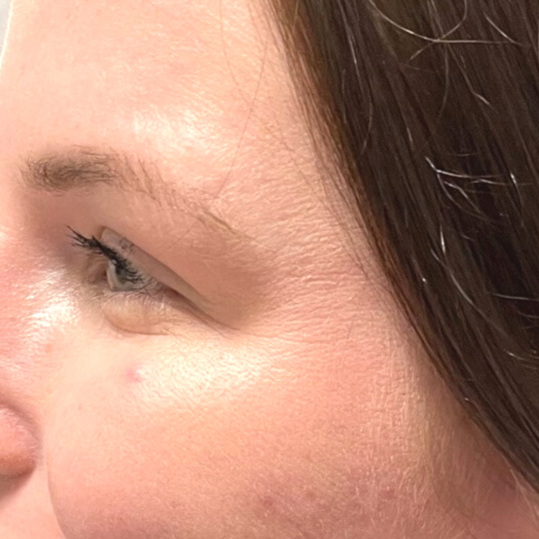 Injectables After Patient 18