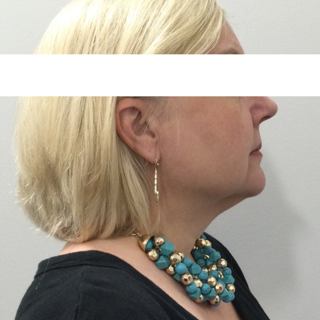 Injectables After Patient 19