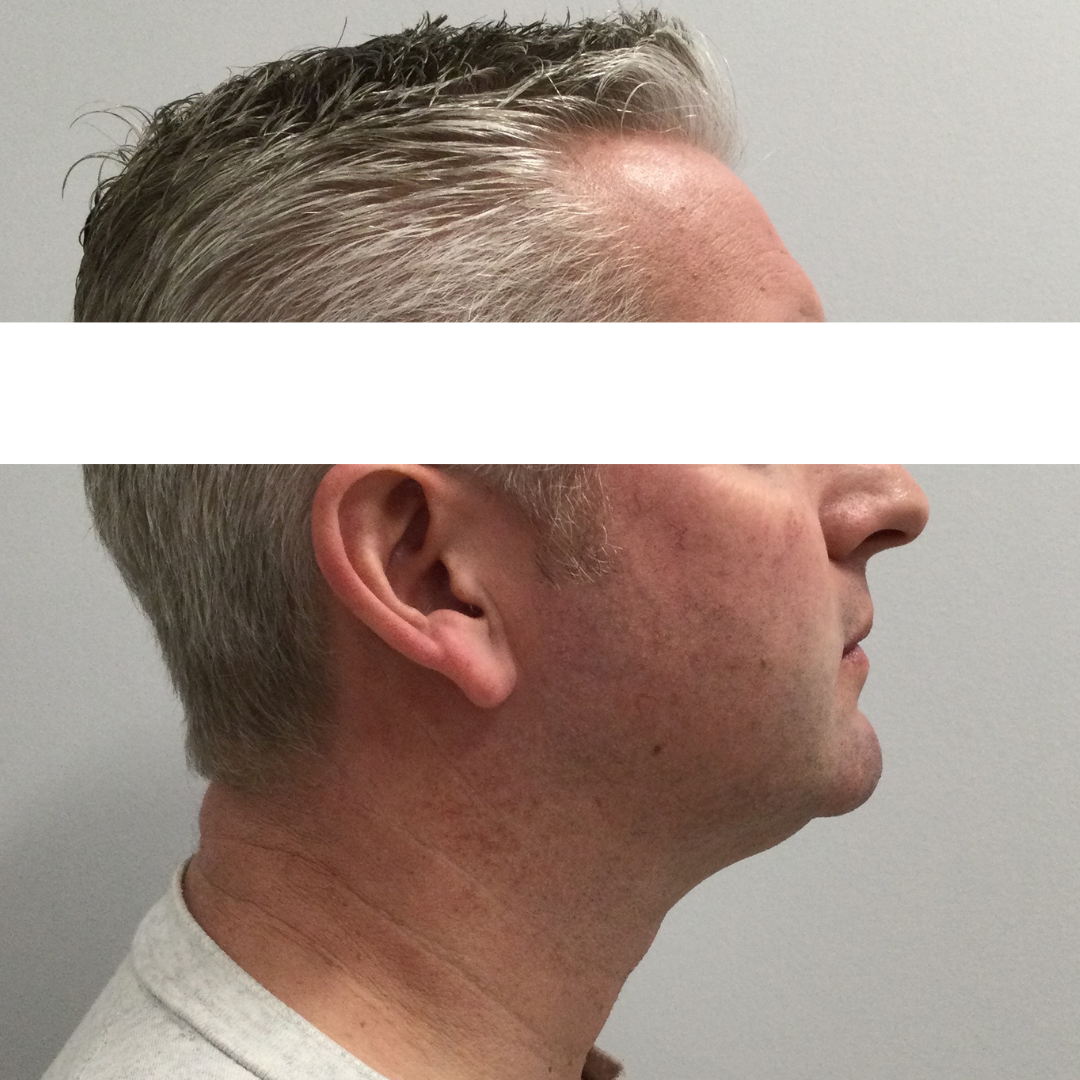 Kybella® After Patient 5