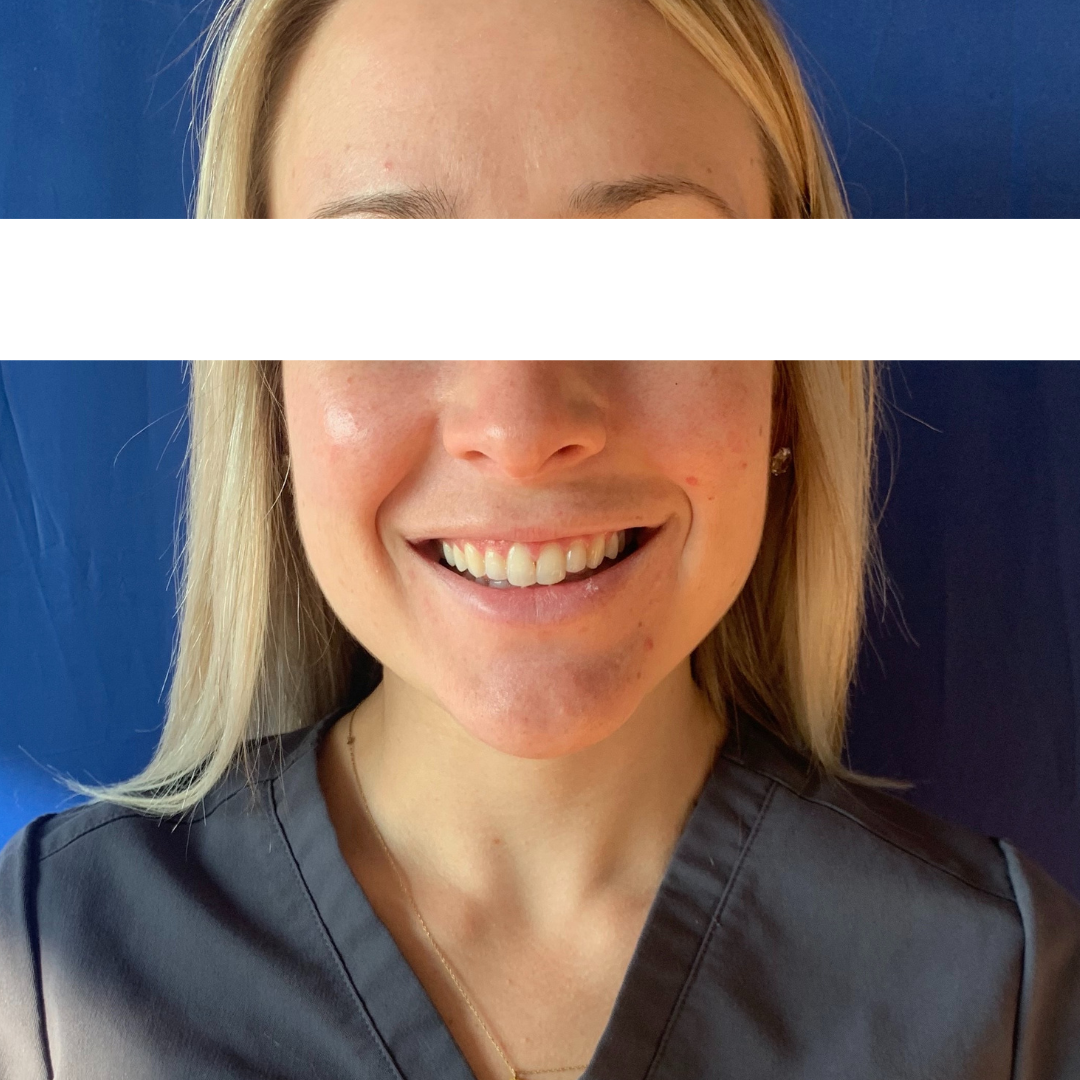 Botox and Dysport Before Patient 7