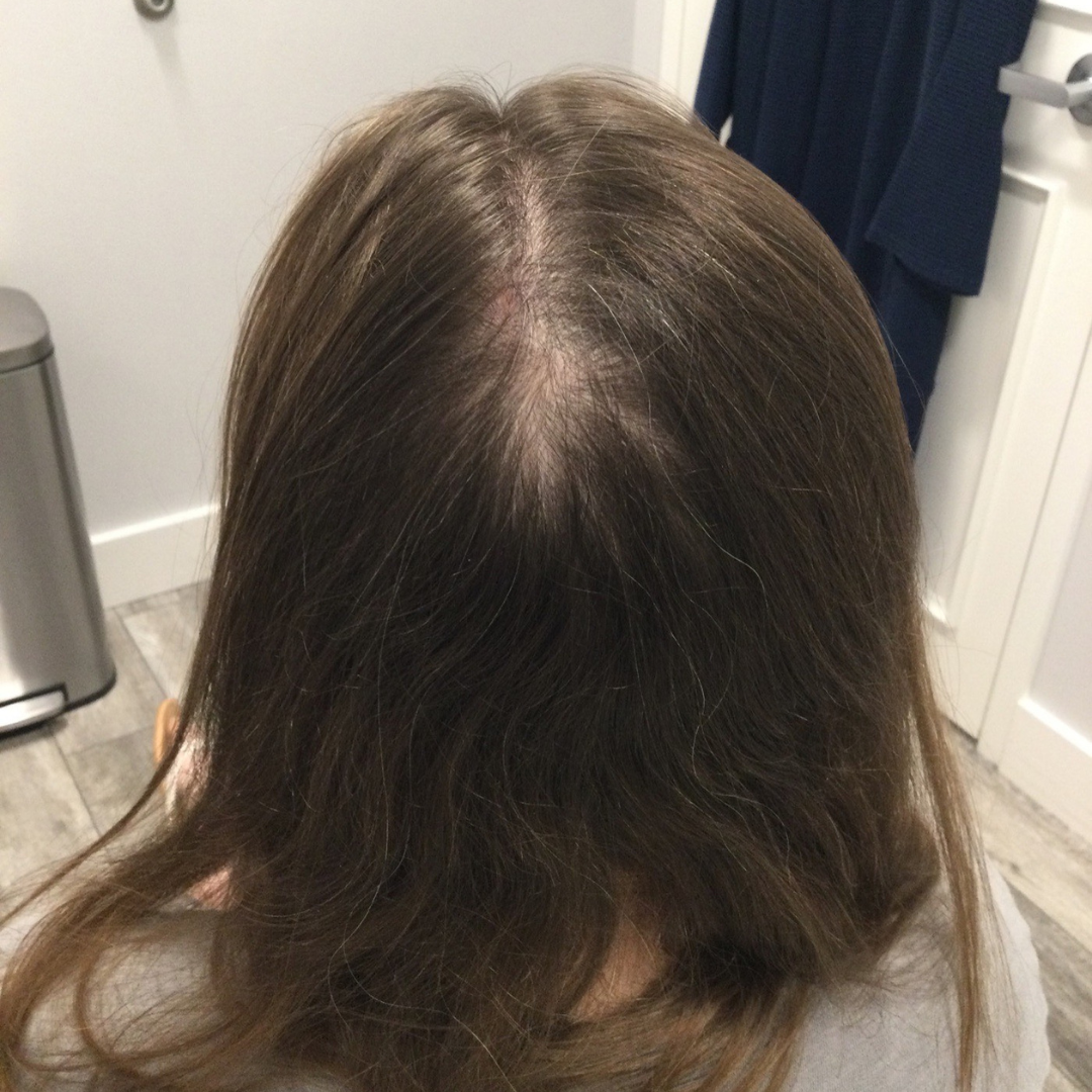 Injectables After Patient 14