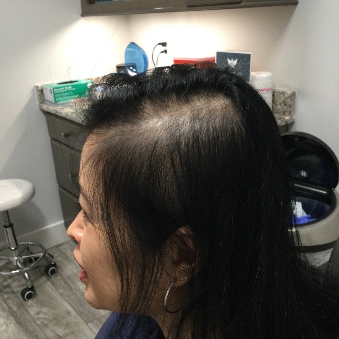 Injectables After Patient 19