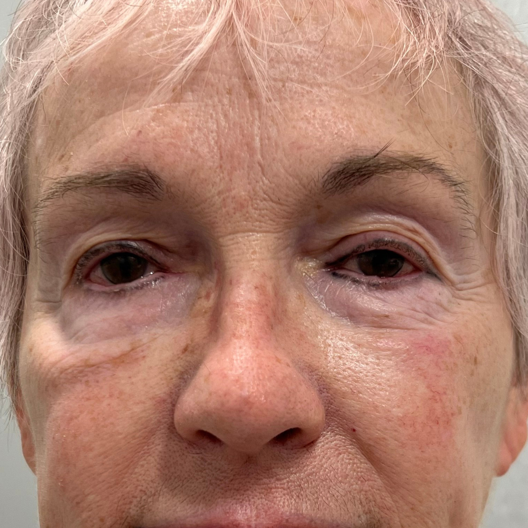 PRF for Undereyes Patient After