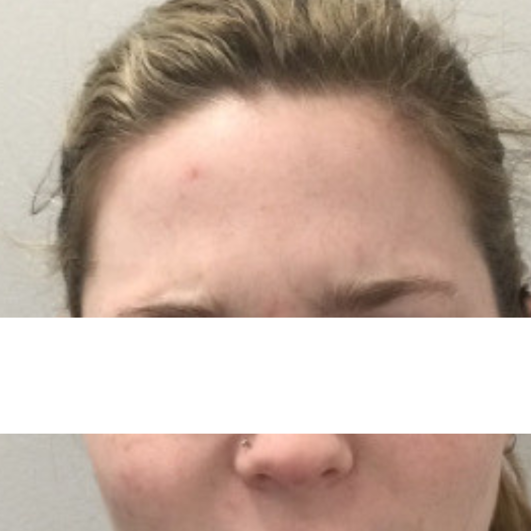Botox and Dysport After Patient 12