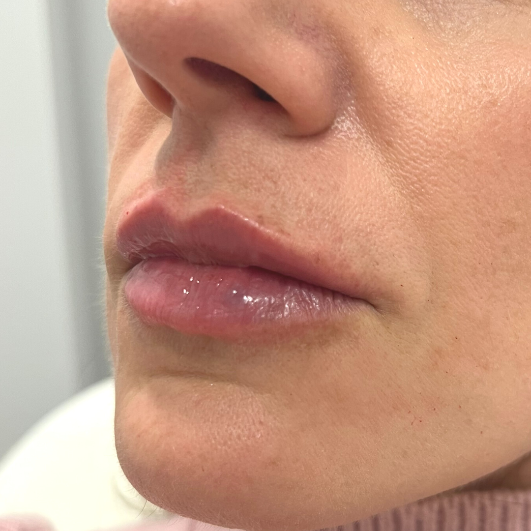 Lip Filler After Patient 5