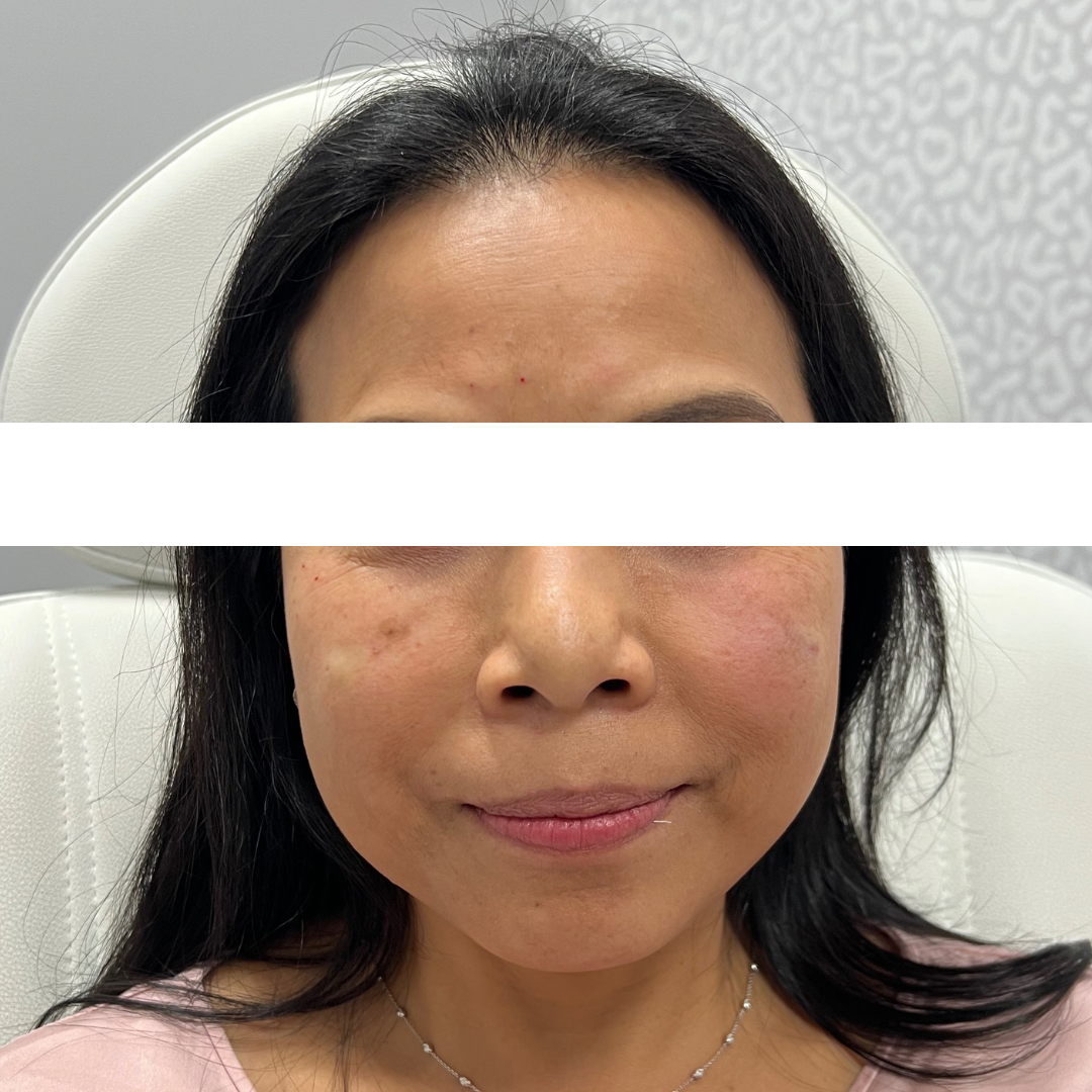 Injectables After Patient 15