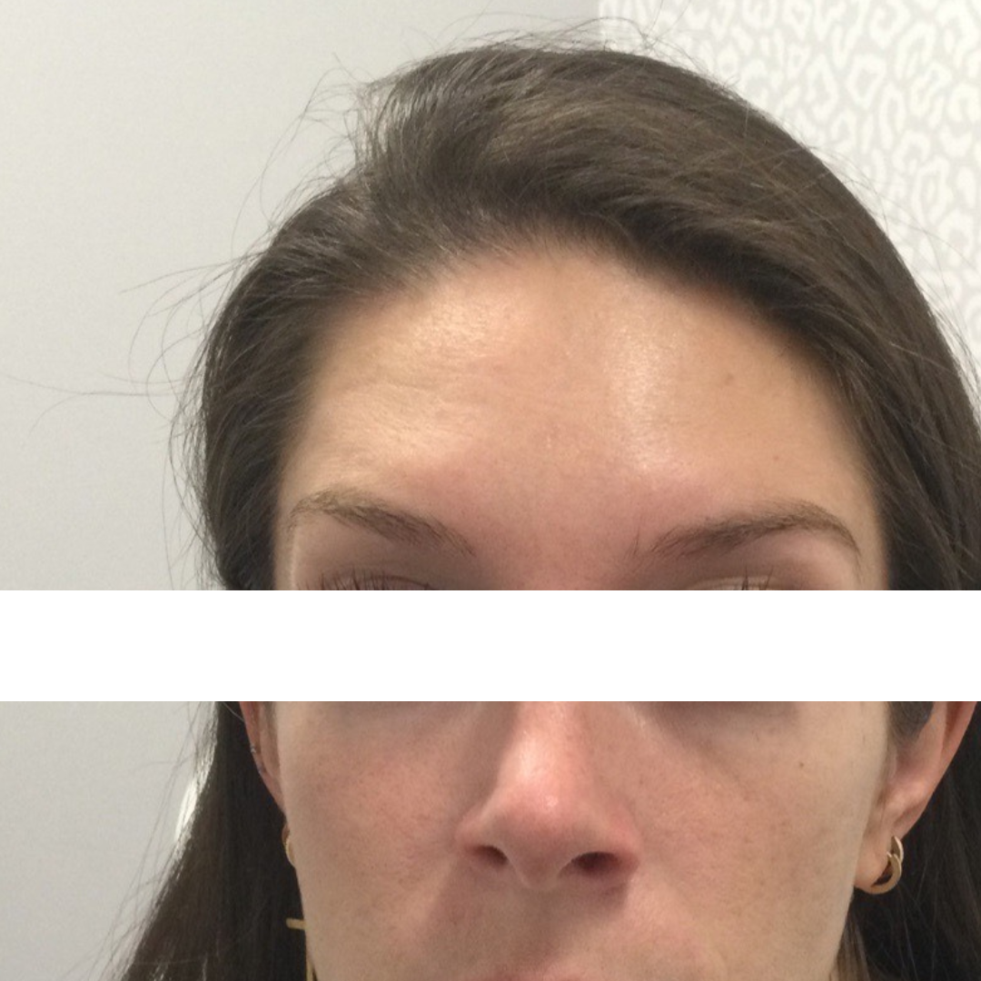 Injectables After Patient 20