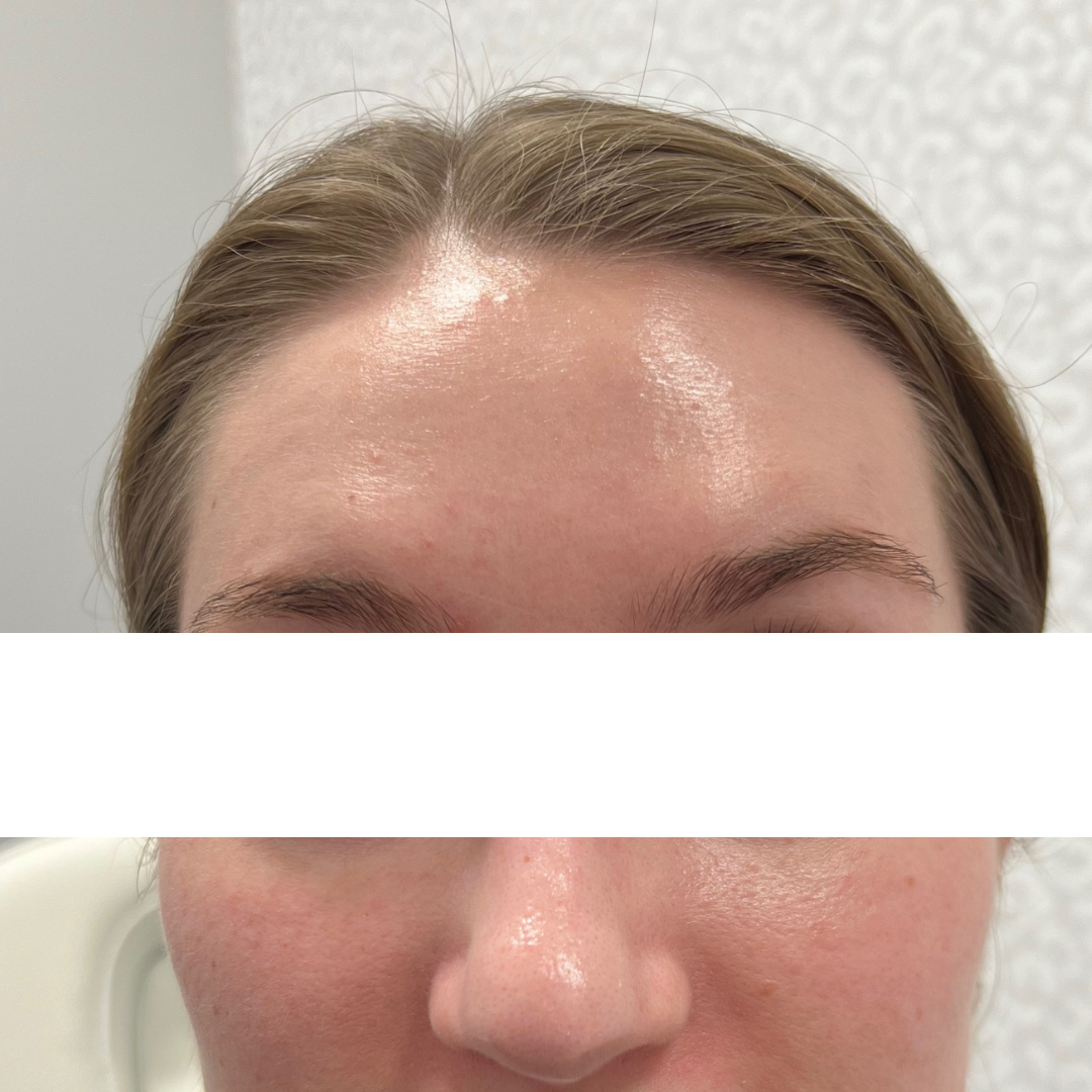 Botox and Dysport After Patient 2