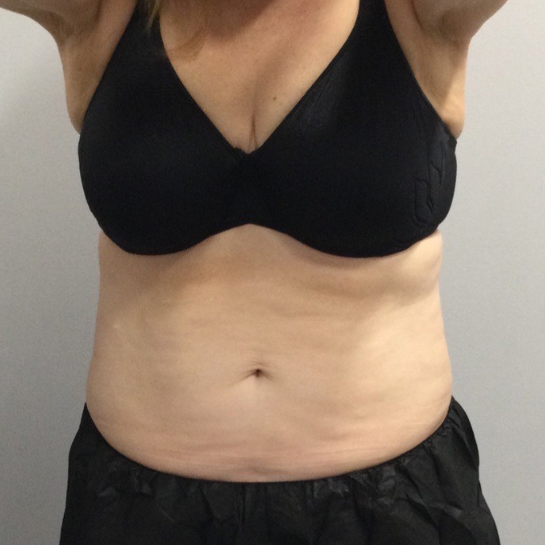 Medical Spa After Patient 2