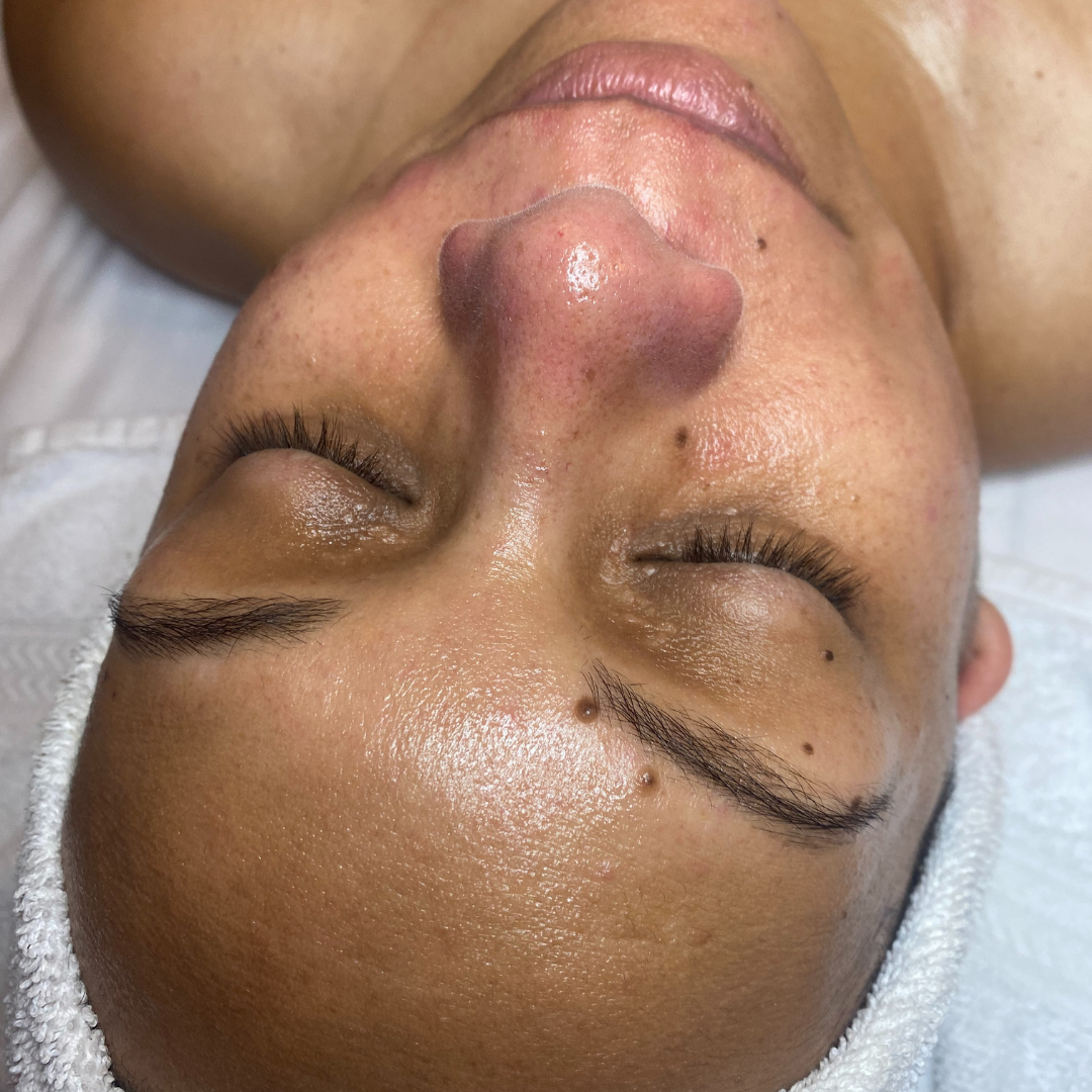 Facials After Patient 1