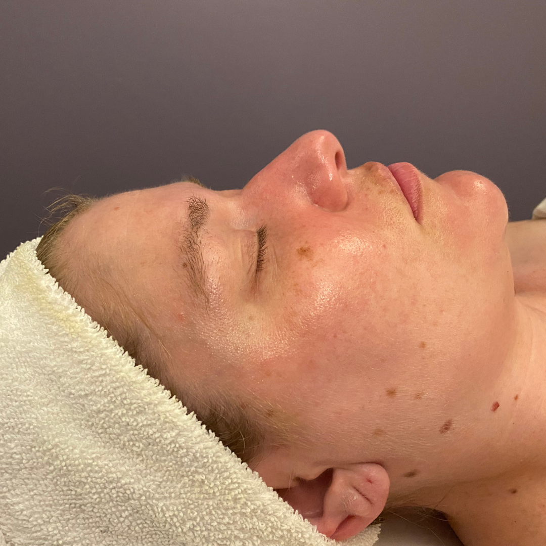 Facials After Patient 2