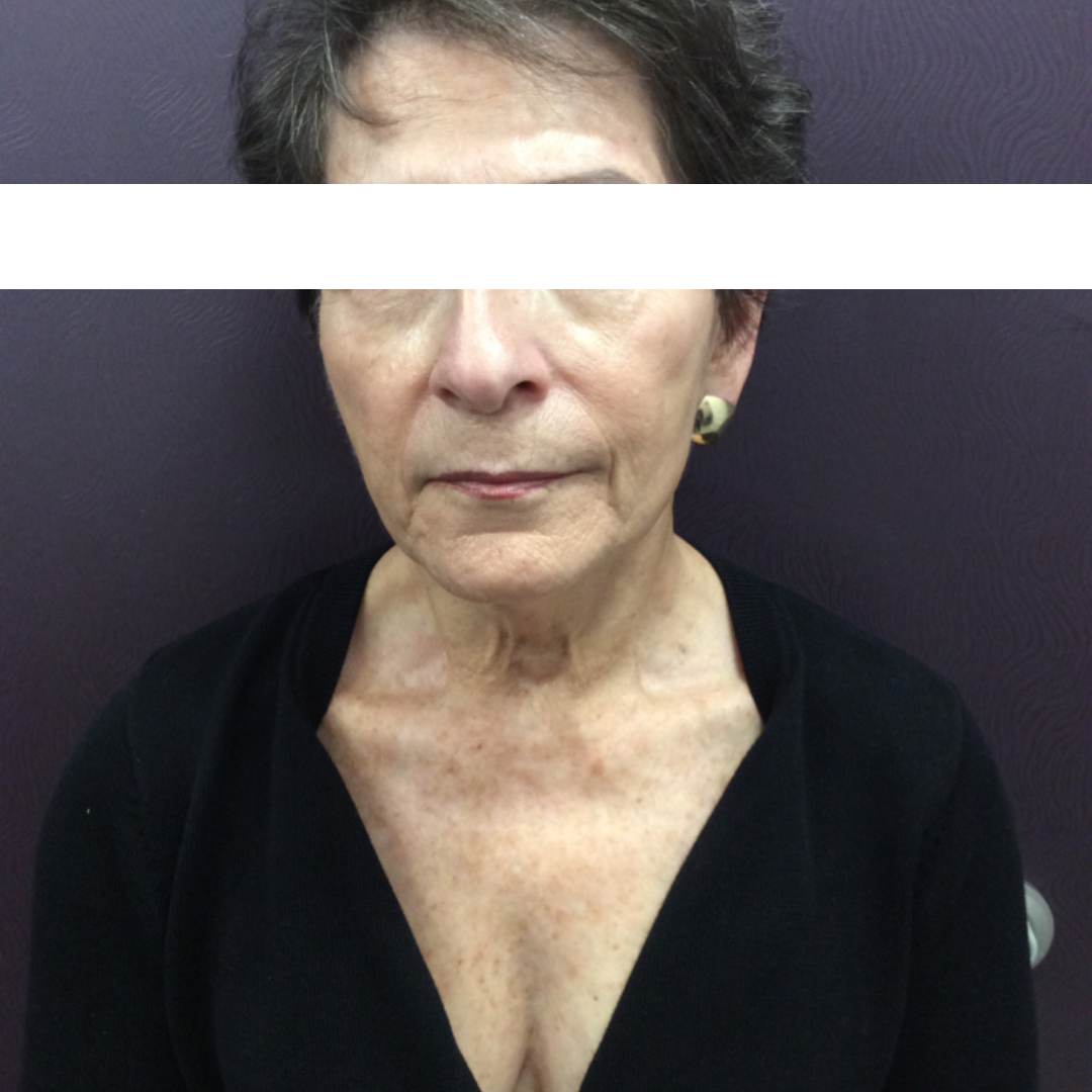 IPL Photo Rejuvenation After Patient 5