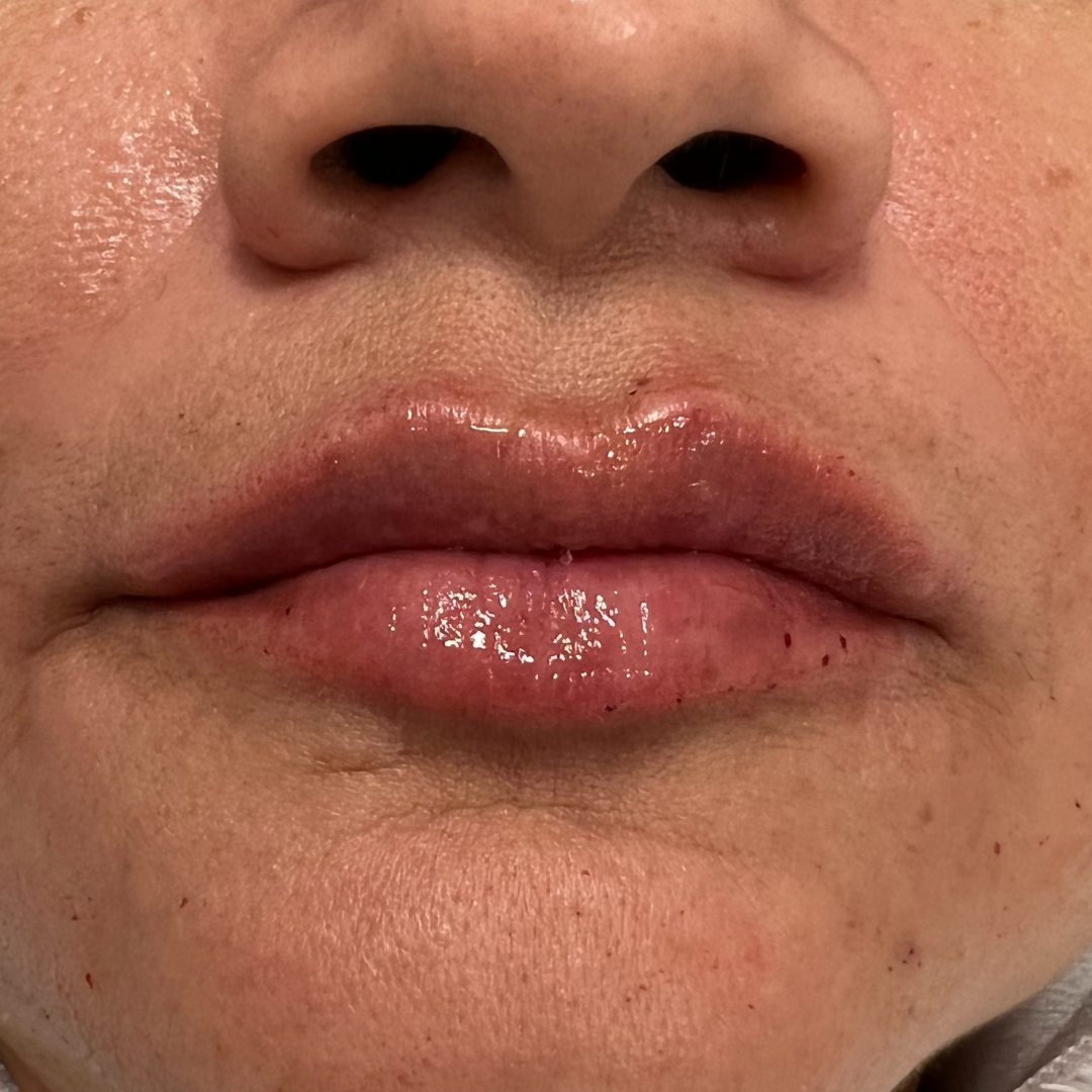Lip Filler After Patient 7