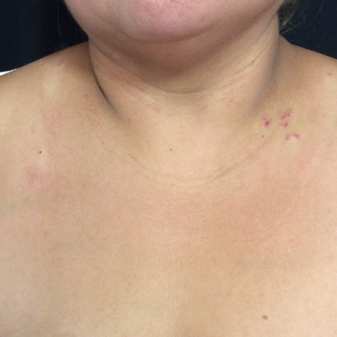 Vein Gogh After Patient 2