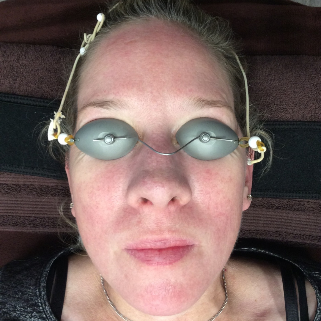 Facials After Patient 3