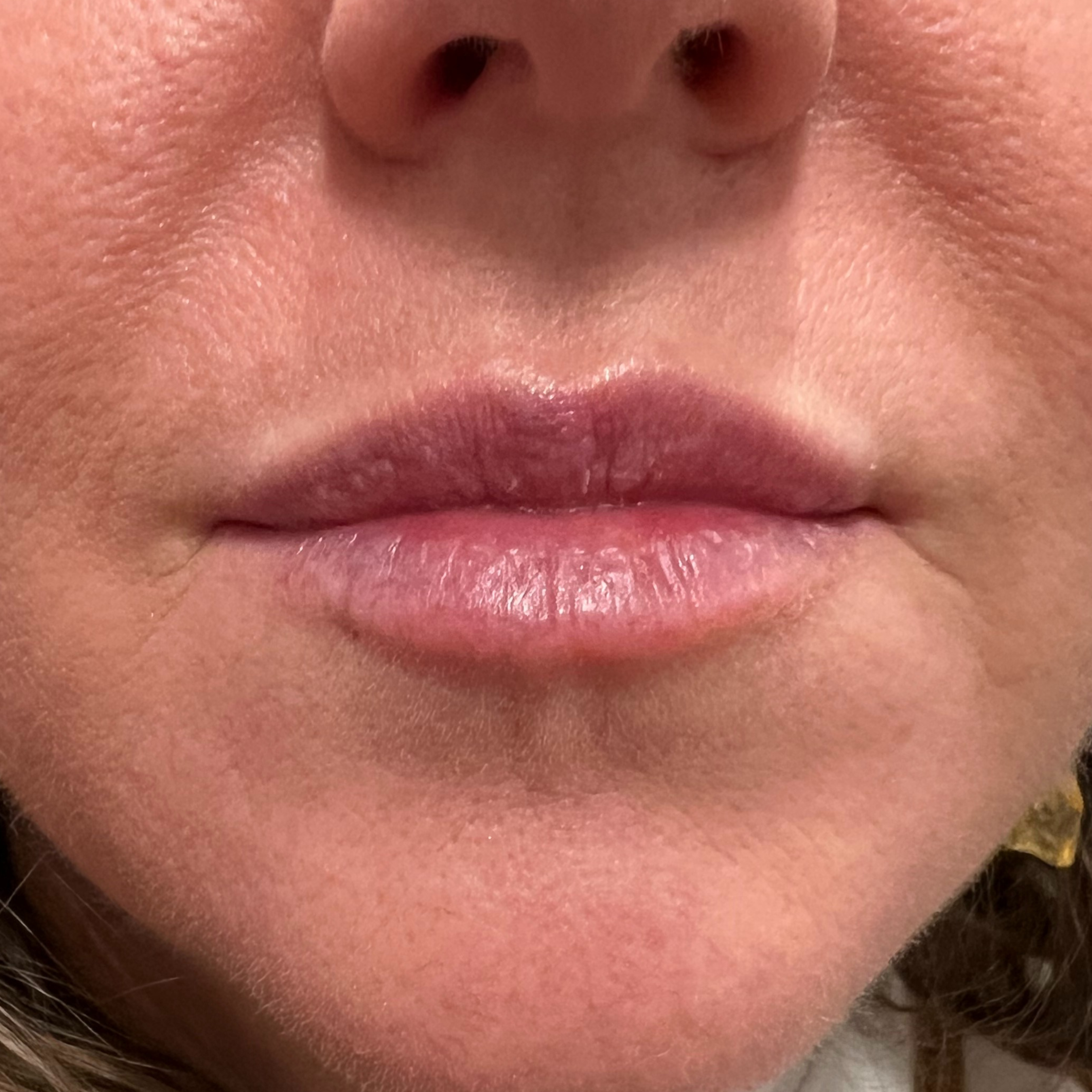 Lip Filler After Patient 33