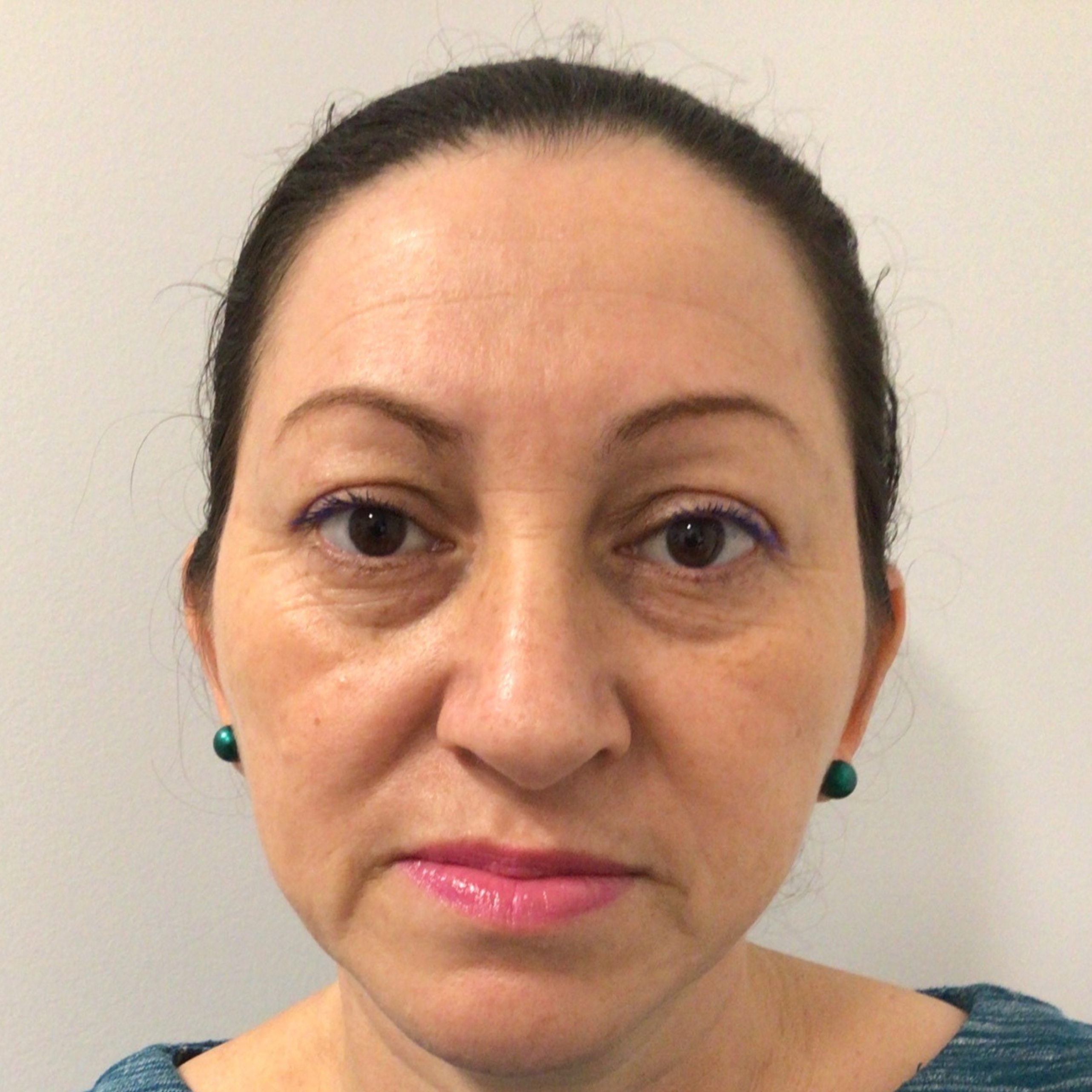 BroadBand Light (BBL) Photo Rejuvenation After Patient 2