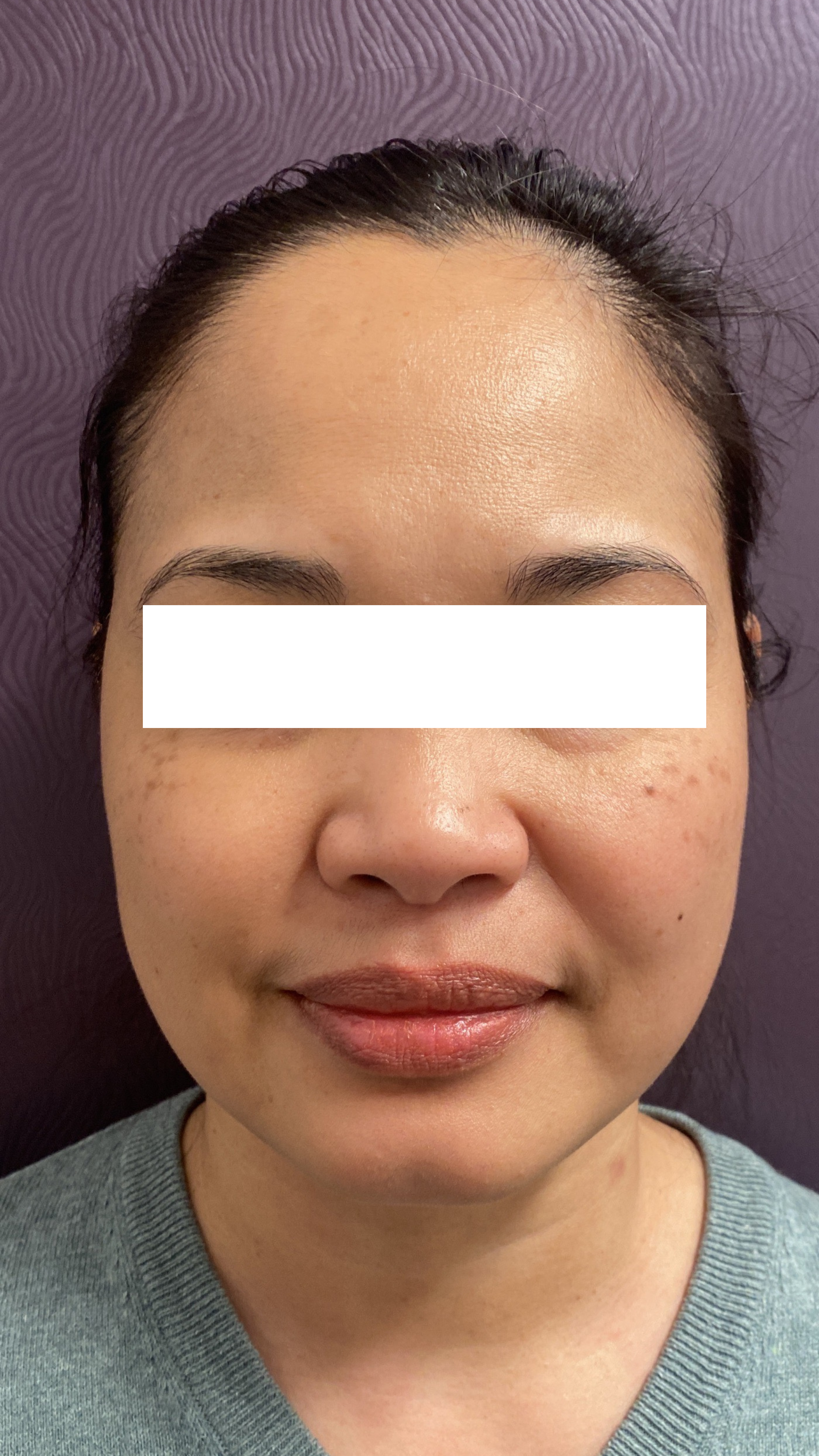 Chemical Peels After Patient 1