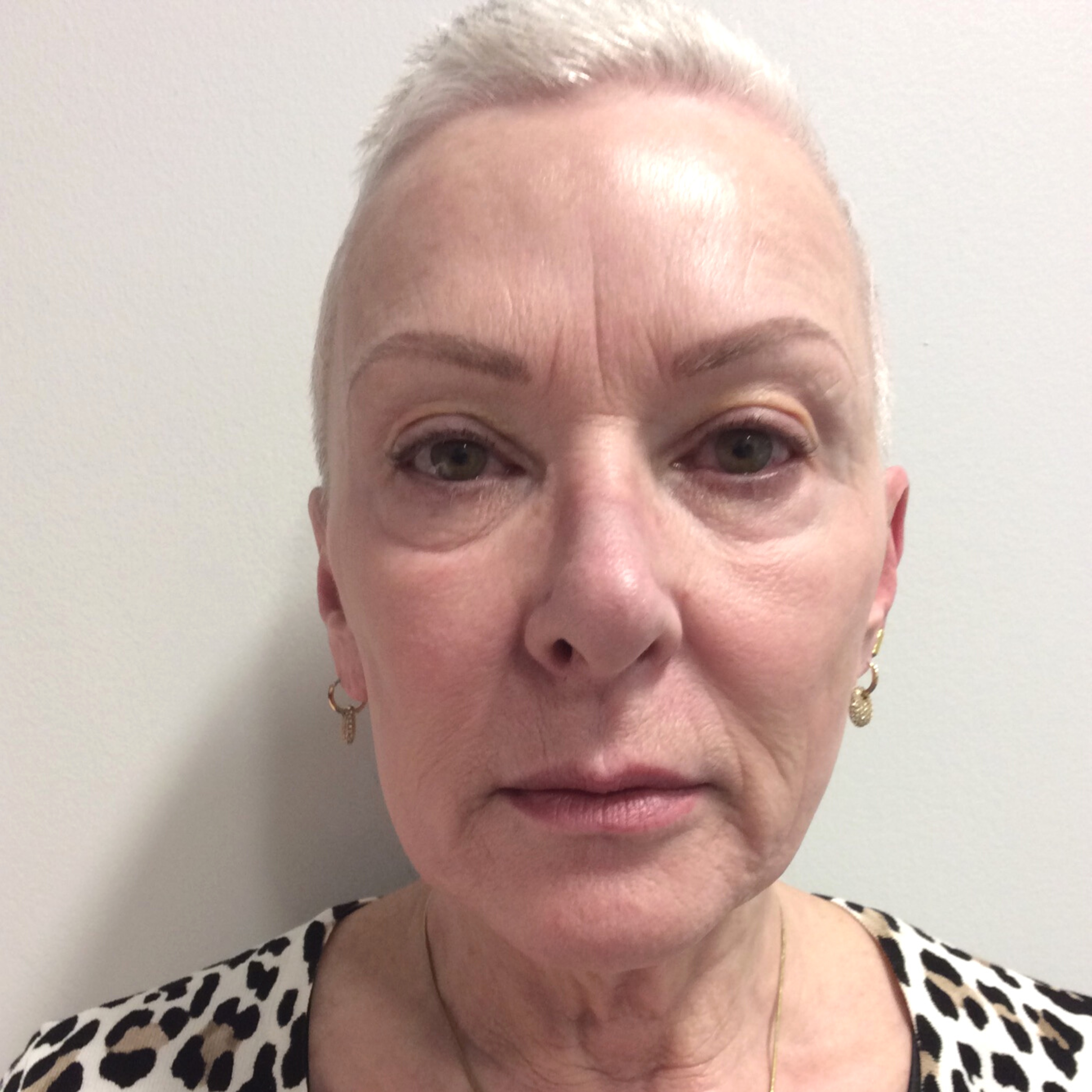 Fraxel After Patient 1