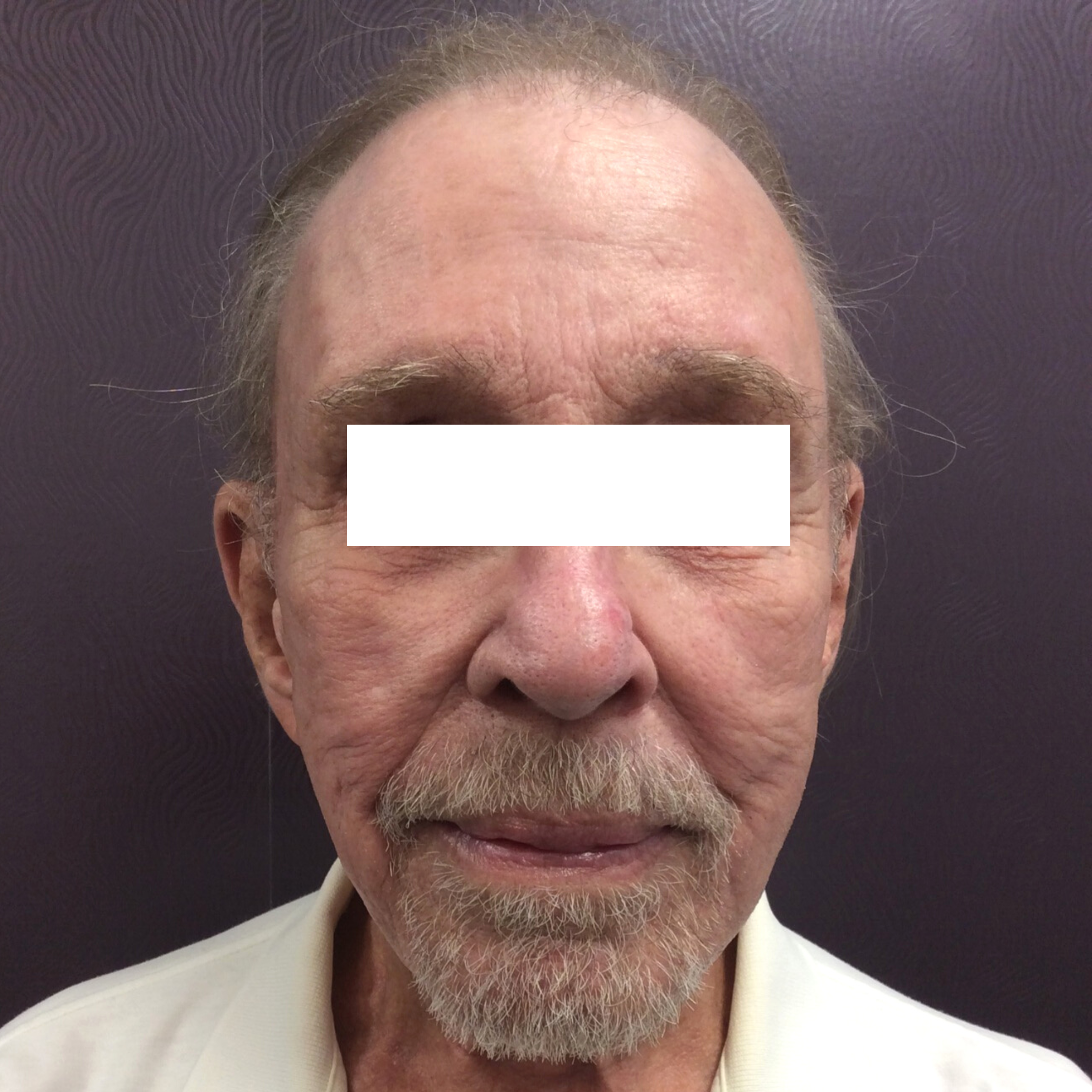 Fraxel After Patient 2