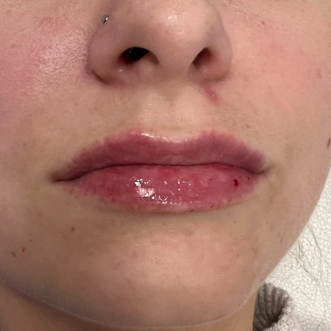 Lip Filler After Patient 9