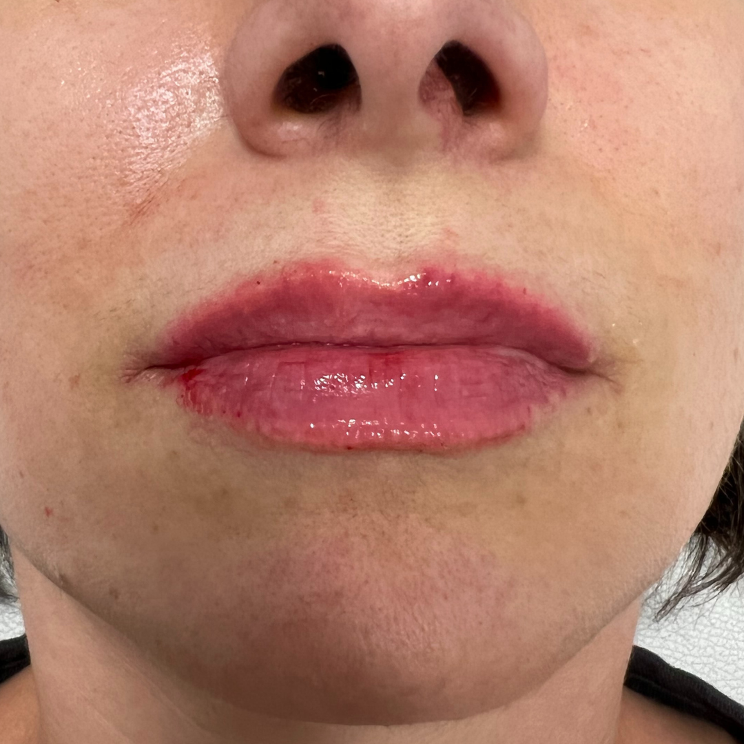 Lip Filler After Patient 11
