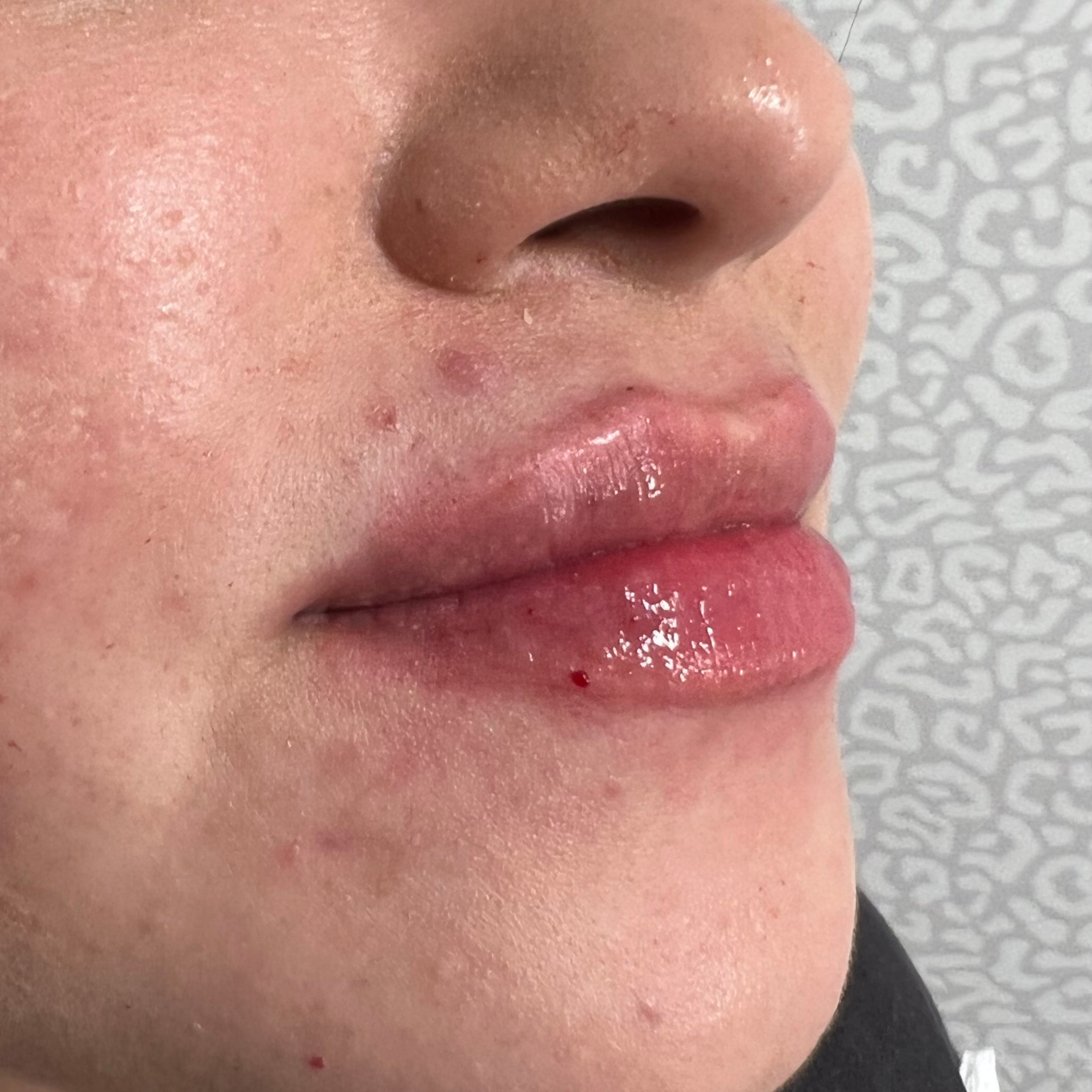 Lip Filler After Patient 11