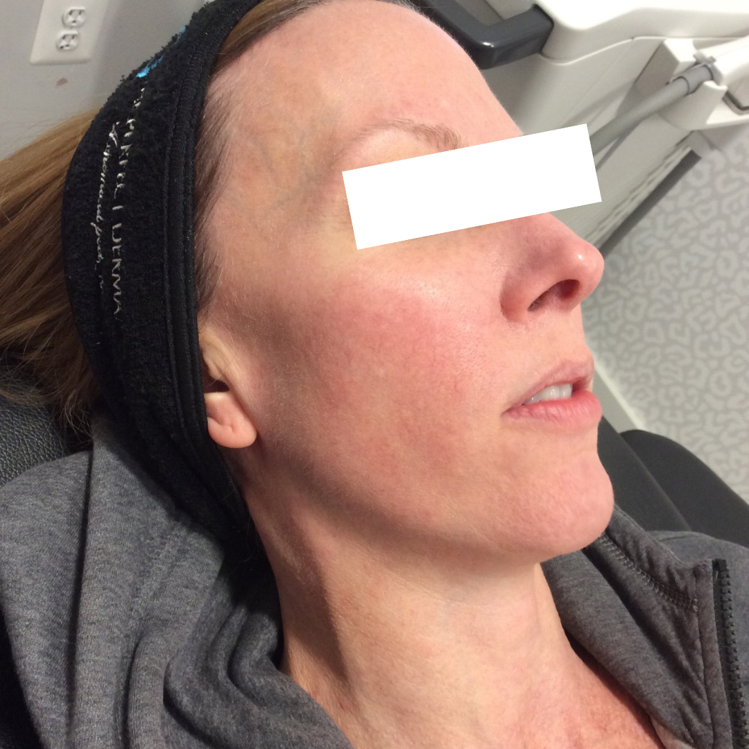 BroadBand Light (BBL) Photo Rejuvenation After Patient 4