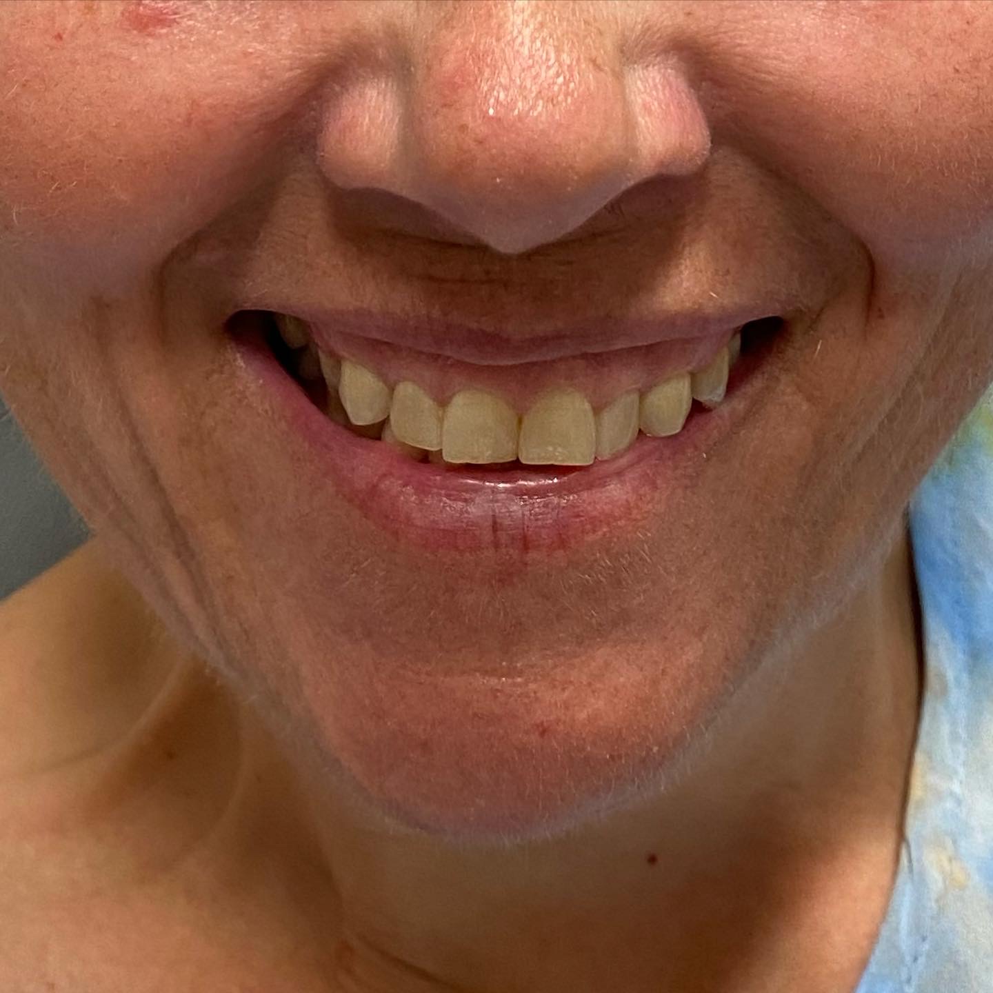 Injectables Before Patient 14