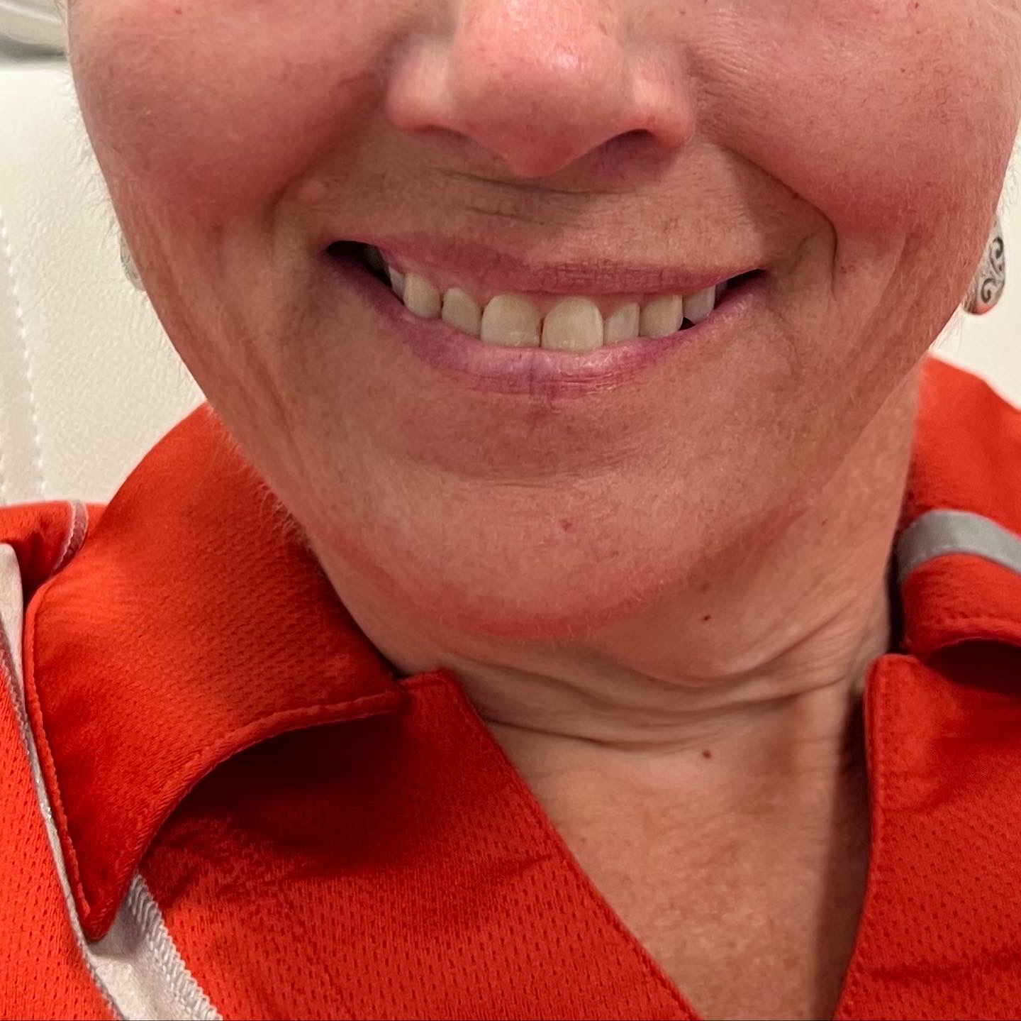 Injectables After Patient 14