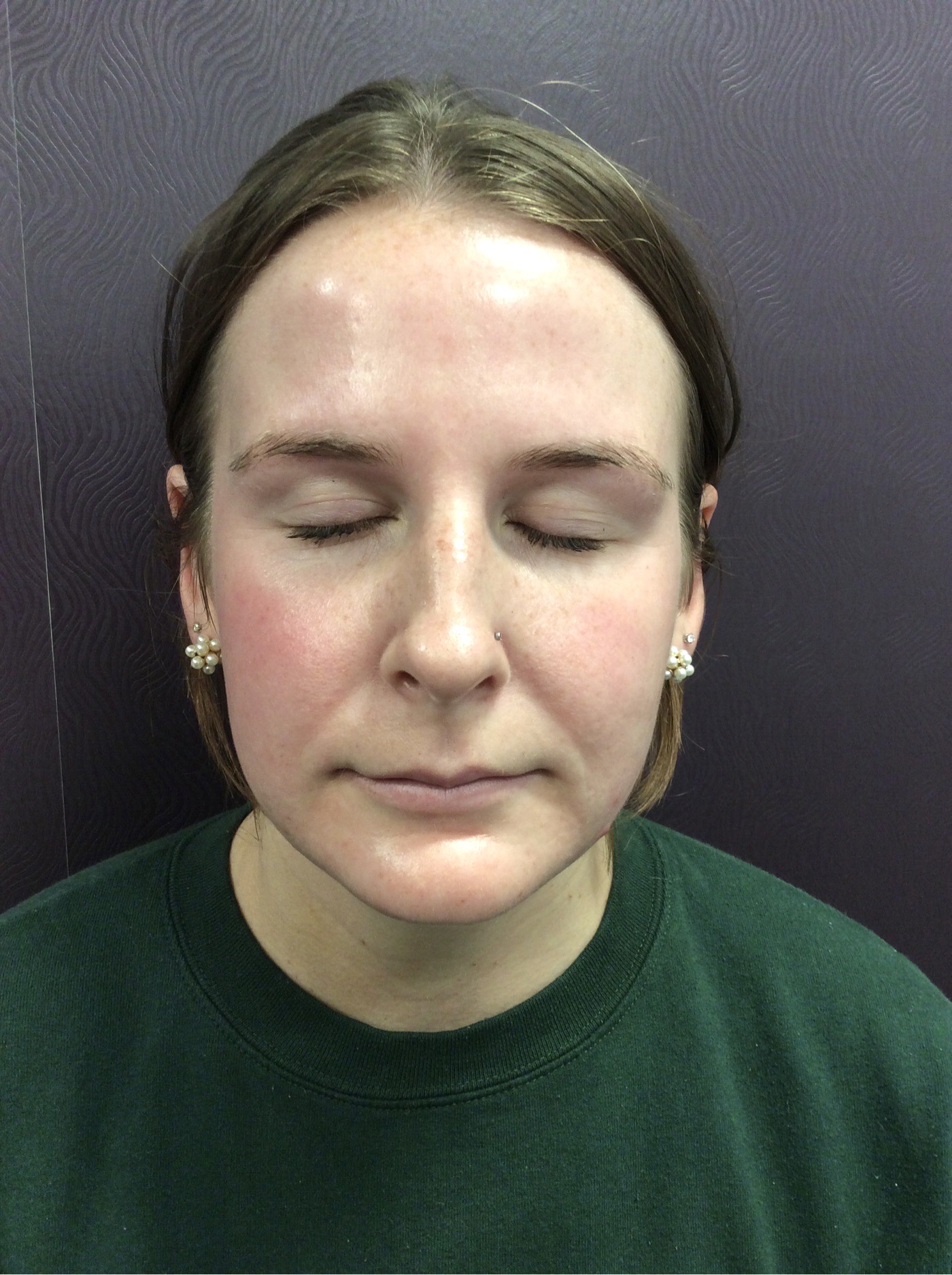 IPL Photo Rejuvenation Before Patient 4