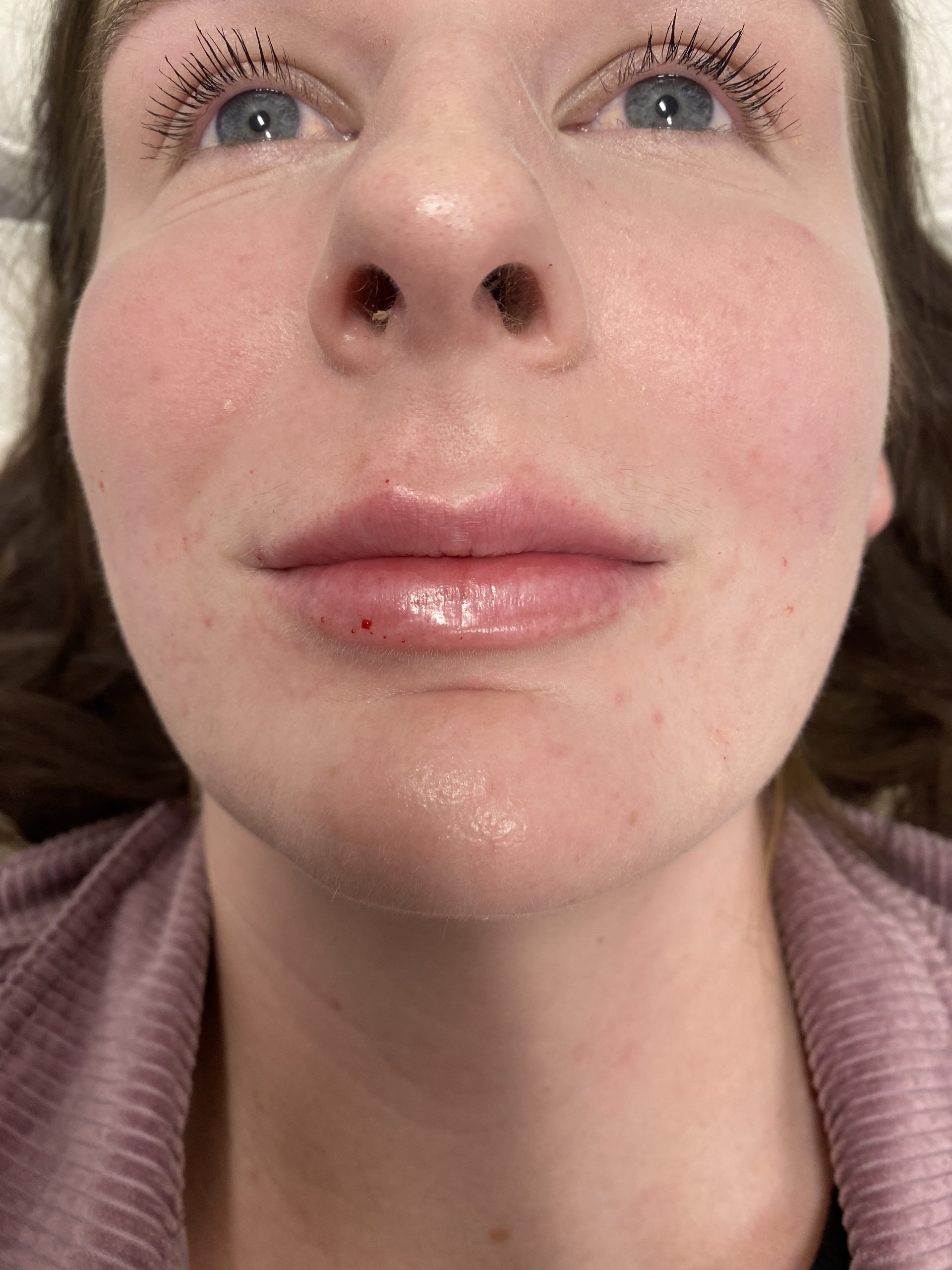 Lip Filler After Patient 1