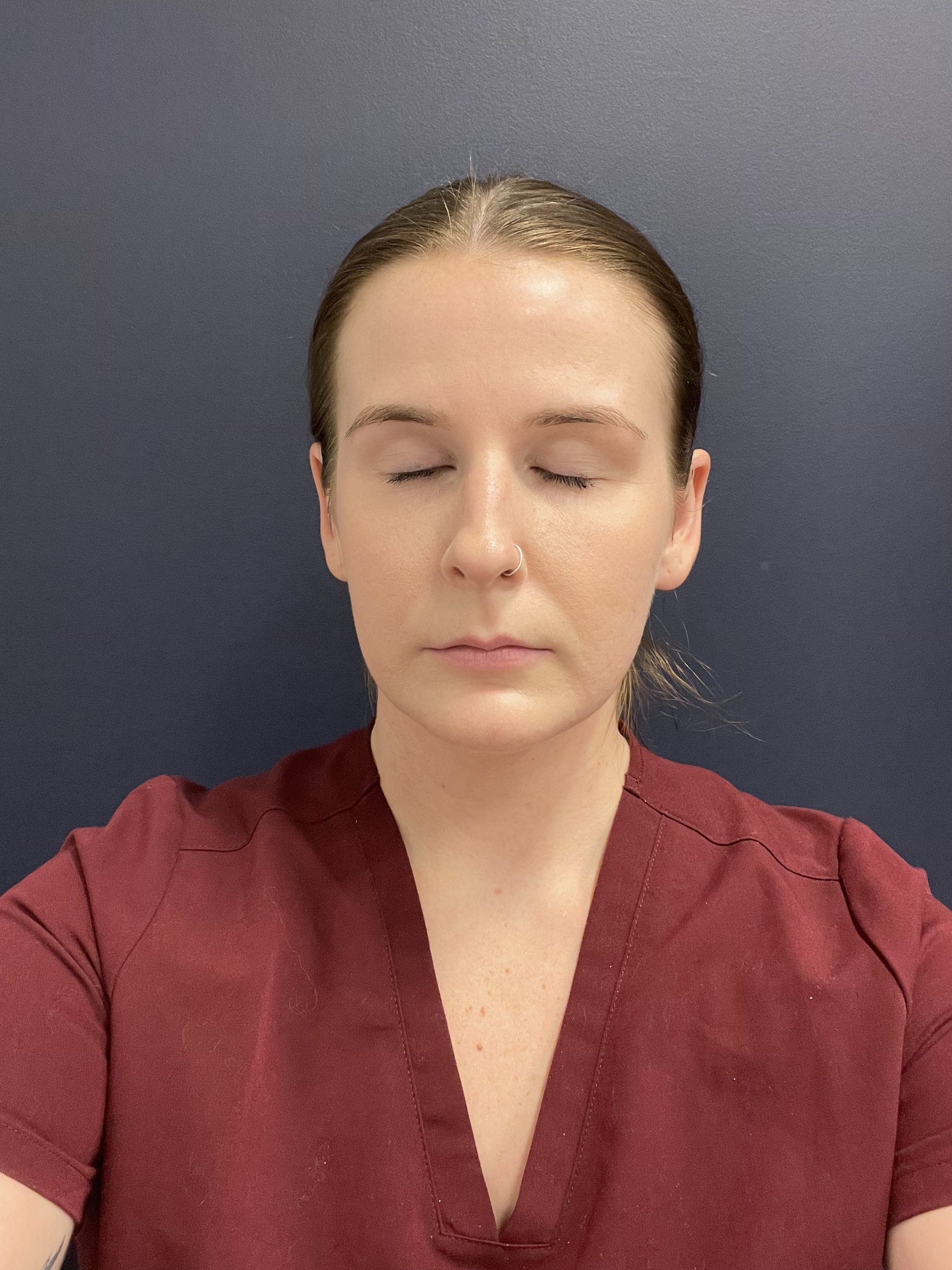 IPL Photo Rejuvenation After Patient 4