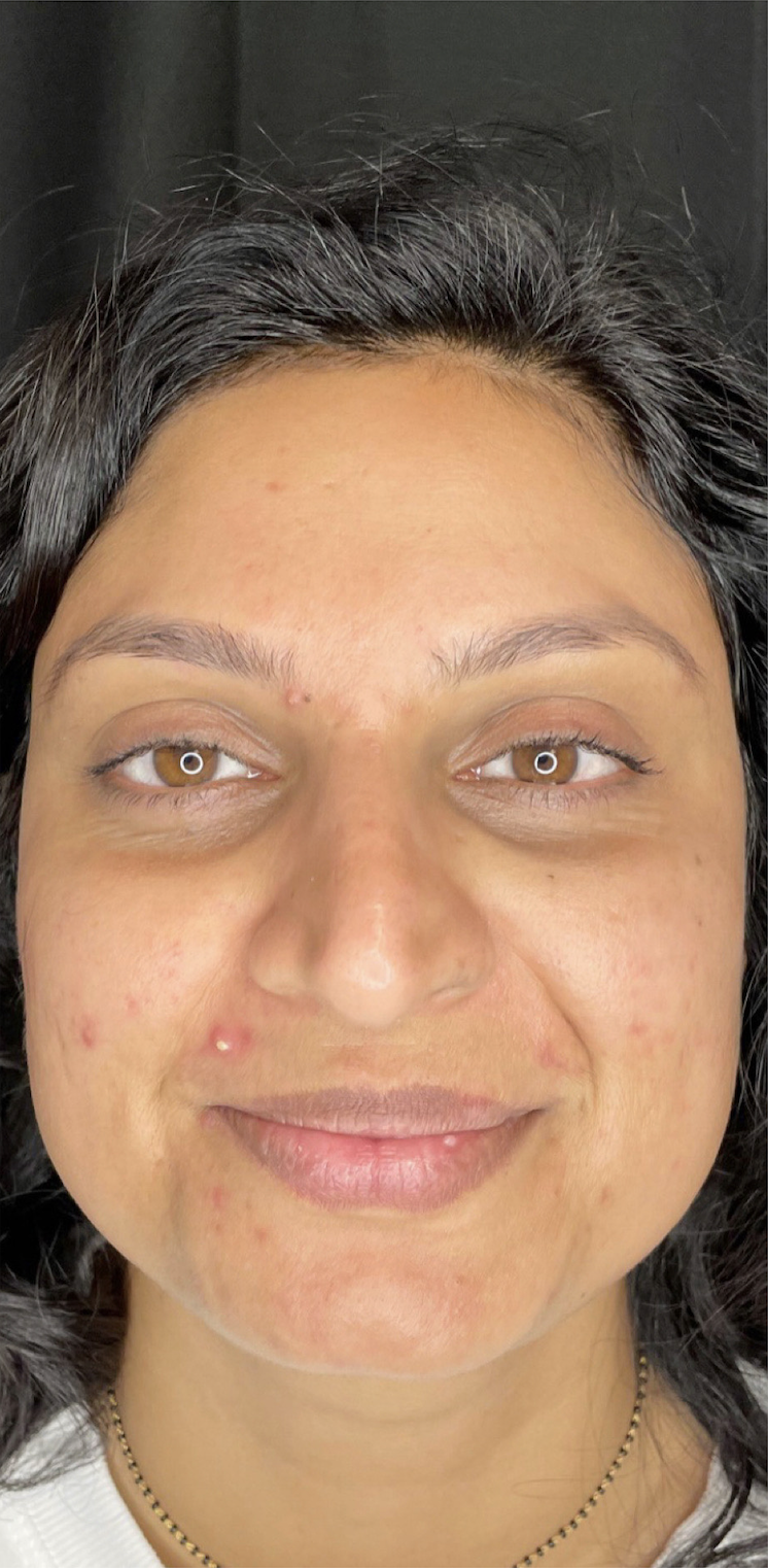 Medical Grade Skin Care Before Patient 4