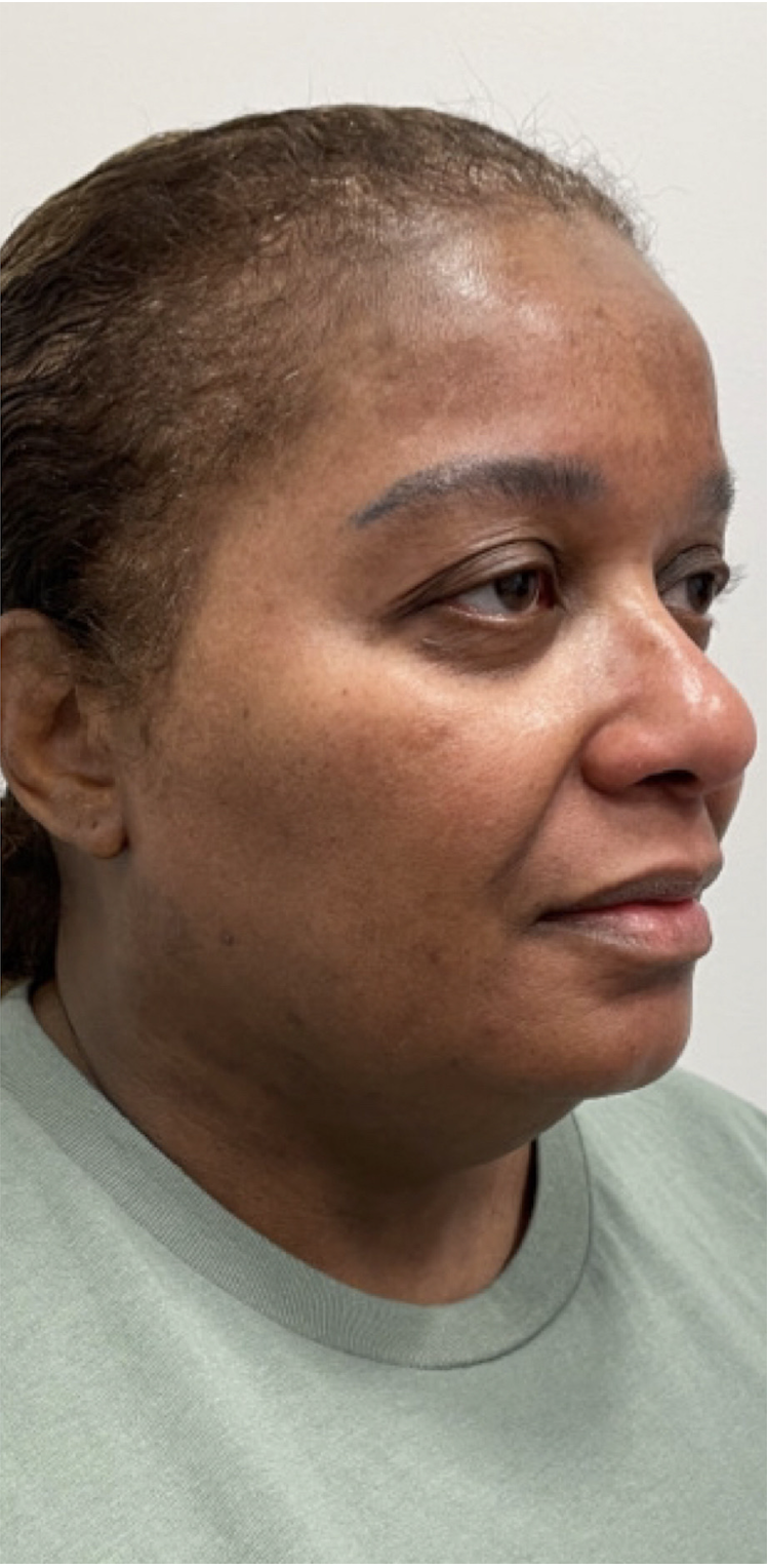 CoolSculpting Before Patient 7