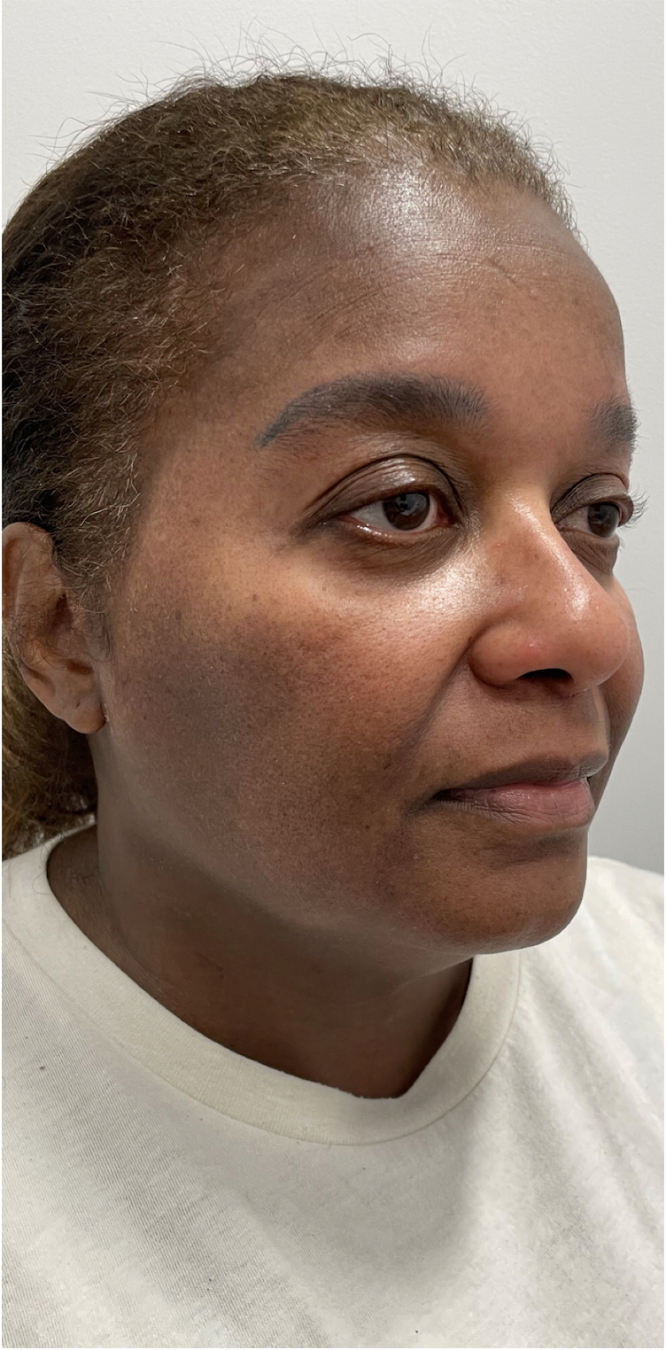 CoolSculpting After Patient 7