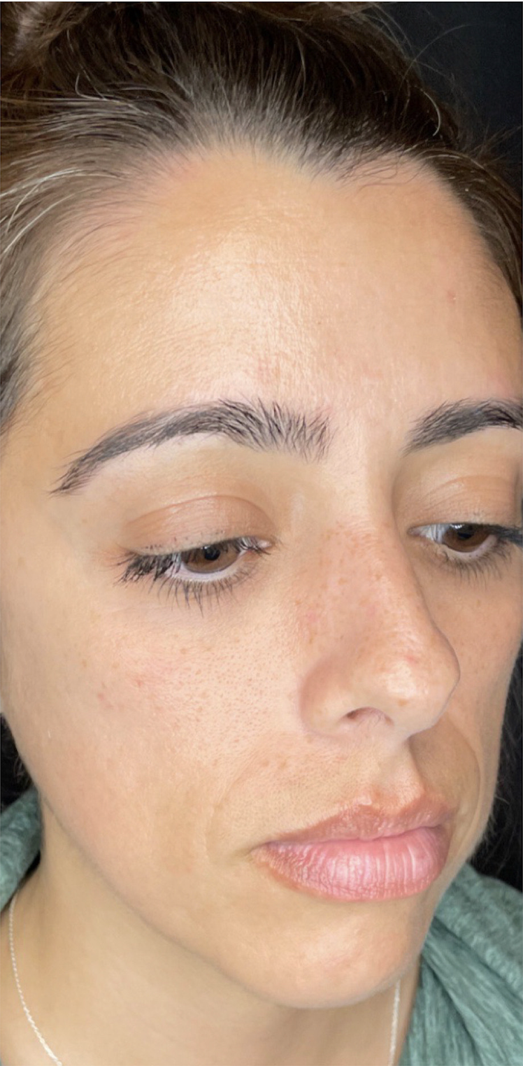 Medical Grade Skin Care Before Patient 5