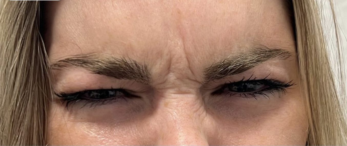 Botox and Dysport Before Patient 13