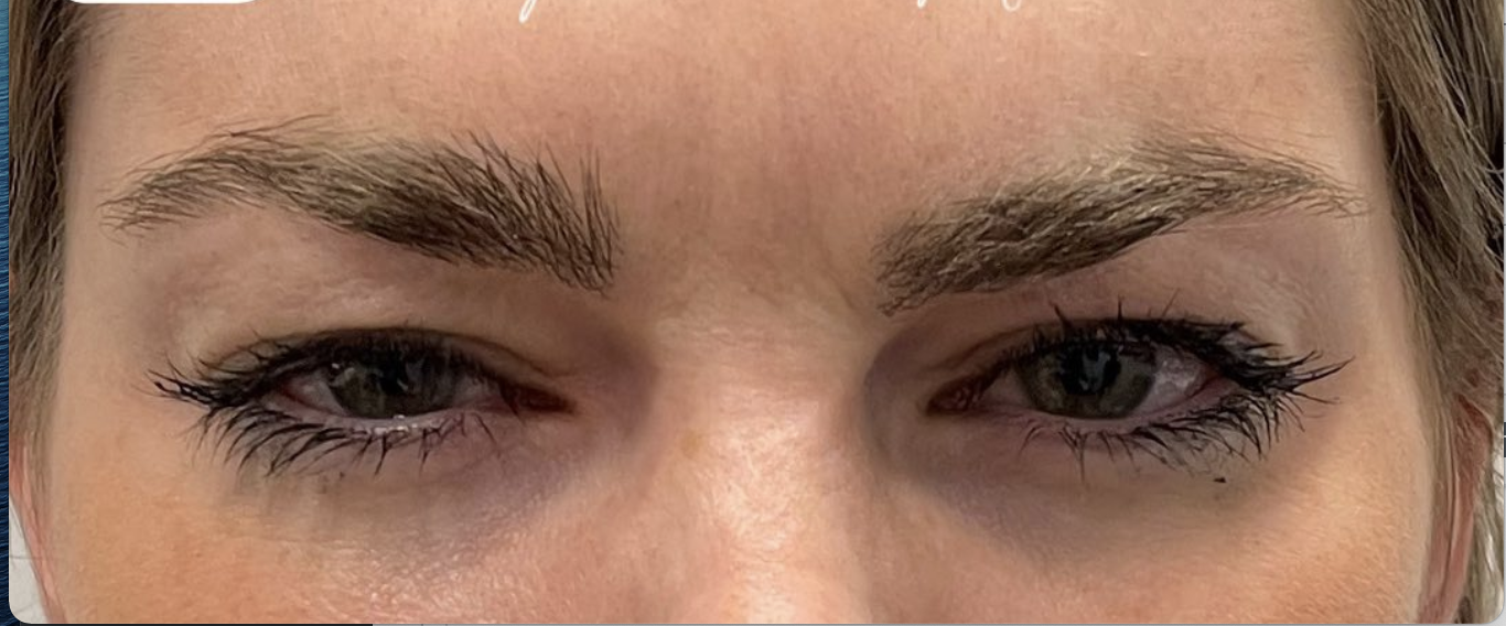 Botox and Dysport After Patient 13